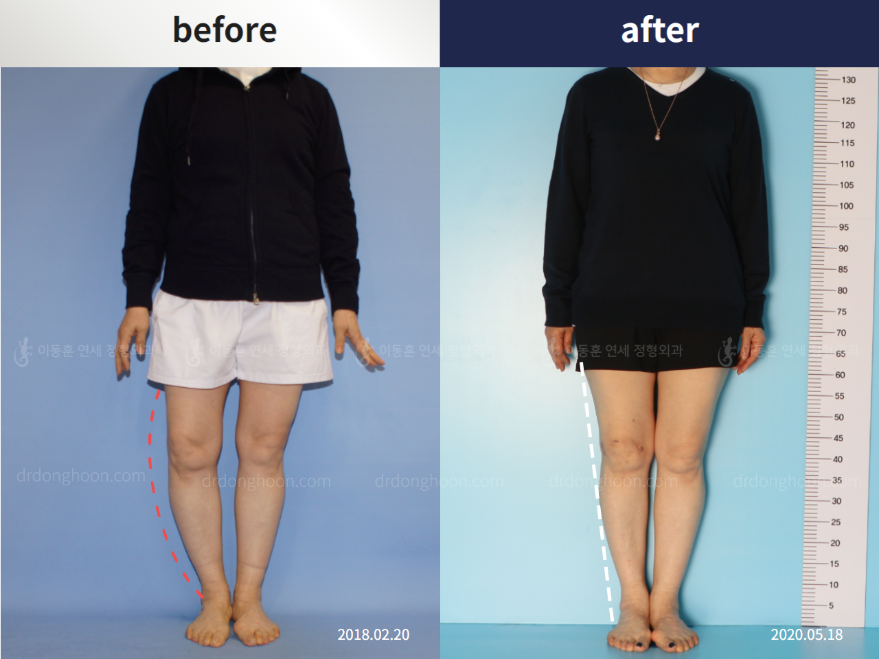 Before and after osteotomy for knee osteoarthritis, case 5409745, image 1, Dr. Donghoon institute (DALRI)