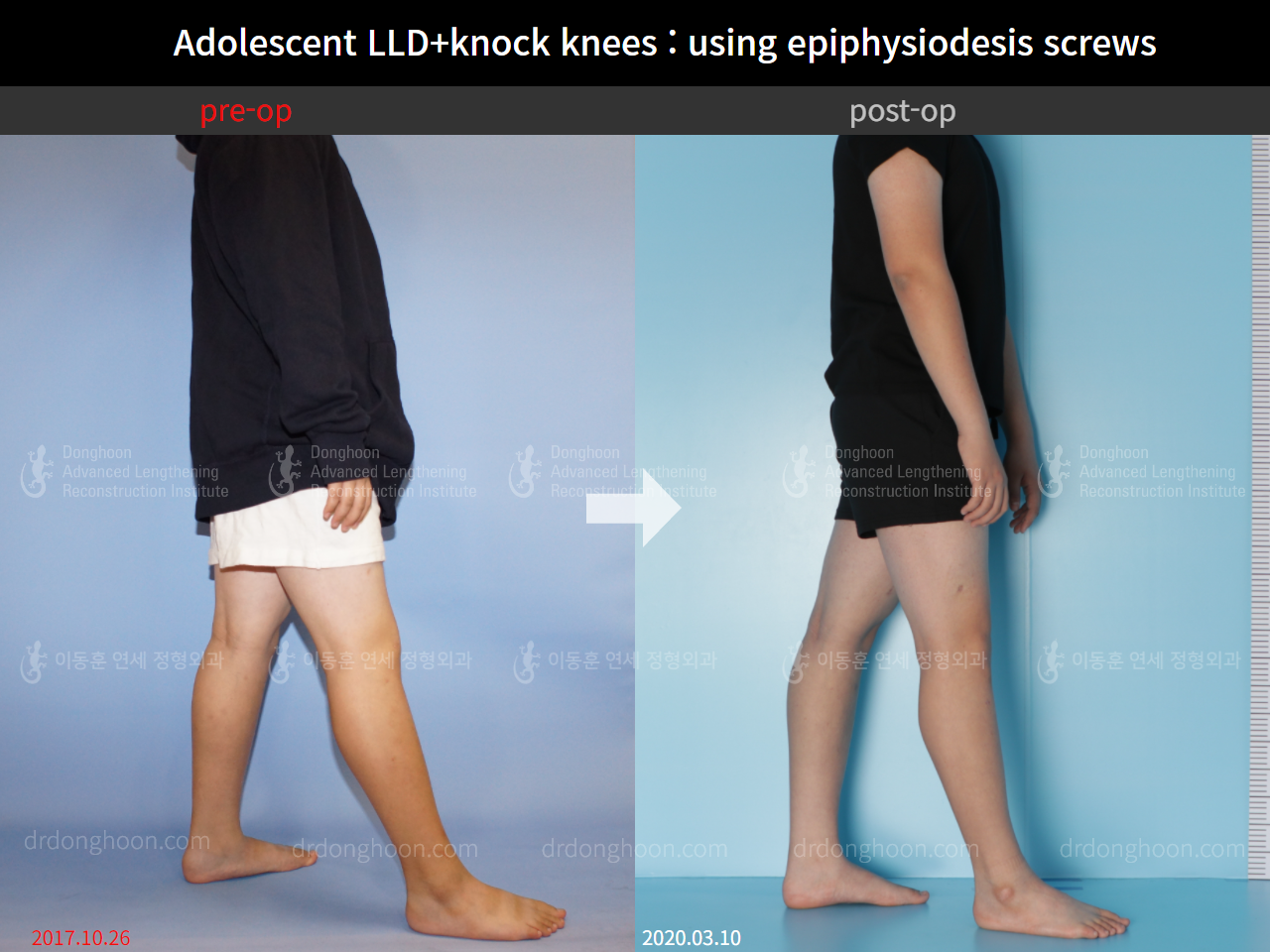 Before and after complex deformity, case 8835405, image 5, Dr. Donghoon institute (DALRI)