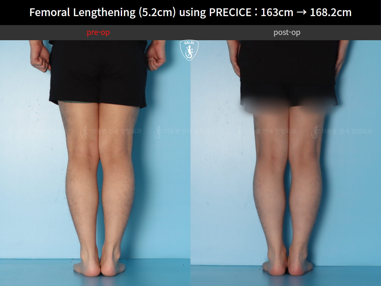Before and after cll precice, case 55585697, image 8, Dr. Donghoon institute (DALRI)