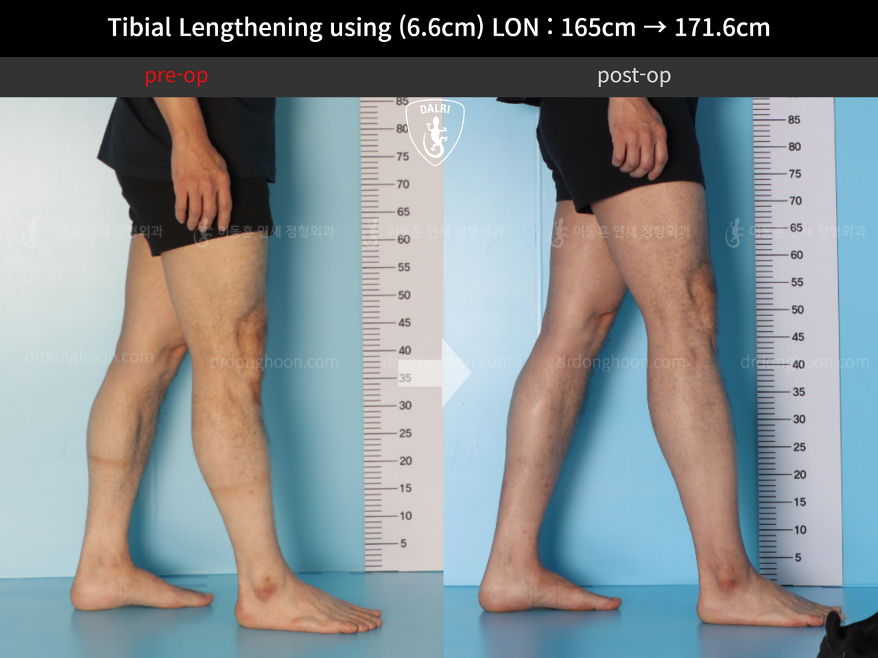 Before and after cll lon, case 12679338, image 7, Dr. Donghoon institute (DALRI)