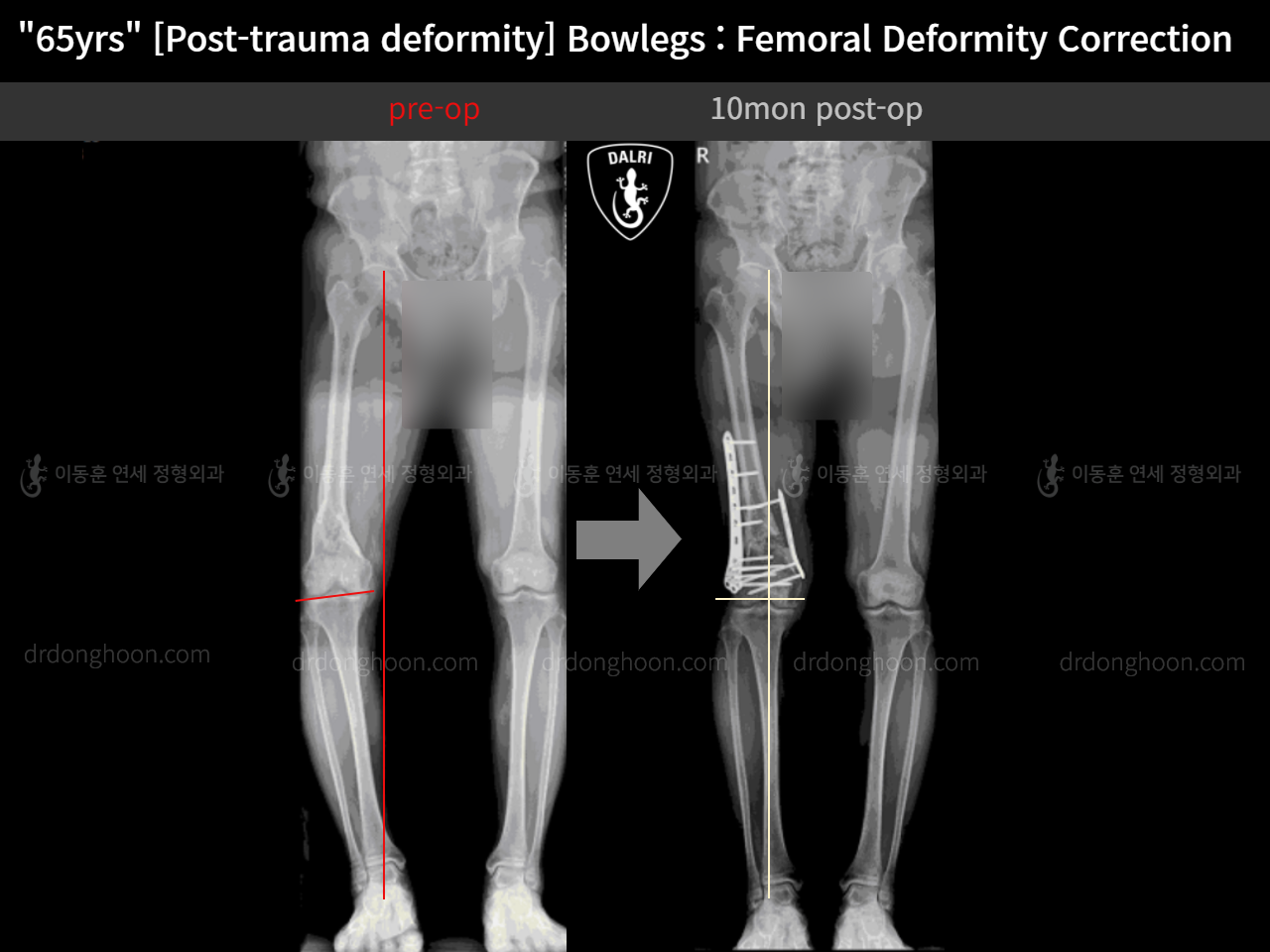 Before and after osteotomy for knee osteoarthritis, case 11675321, image 6, Dr. Donghoon institute (DALRI)