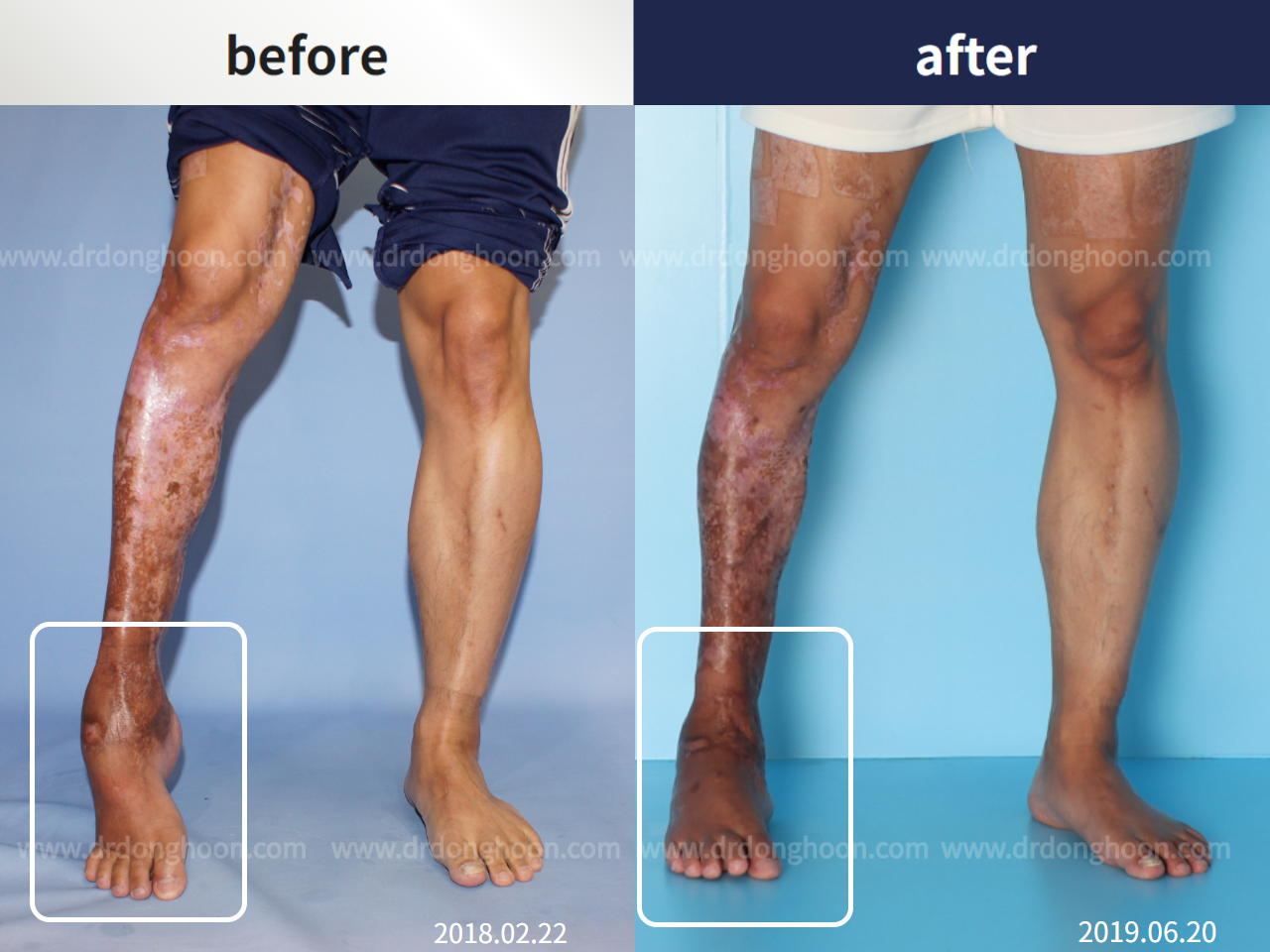 Before and after foot & ankle deformity, case 4248173, image 2, Dr. Donghoon institute (DALRI)