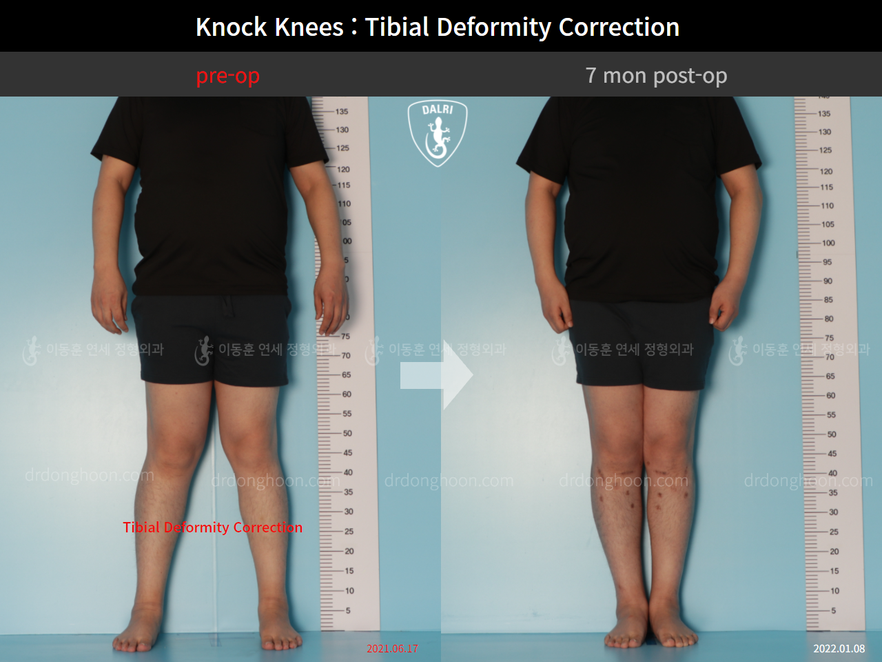 Before and after adult knock knees, case 9393967, image 1, Dr. Donghoon institute (DALRI)