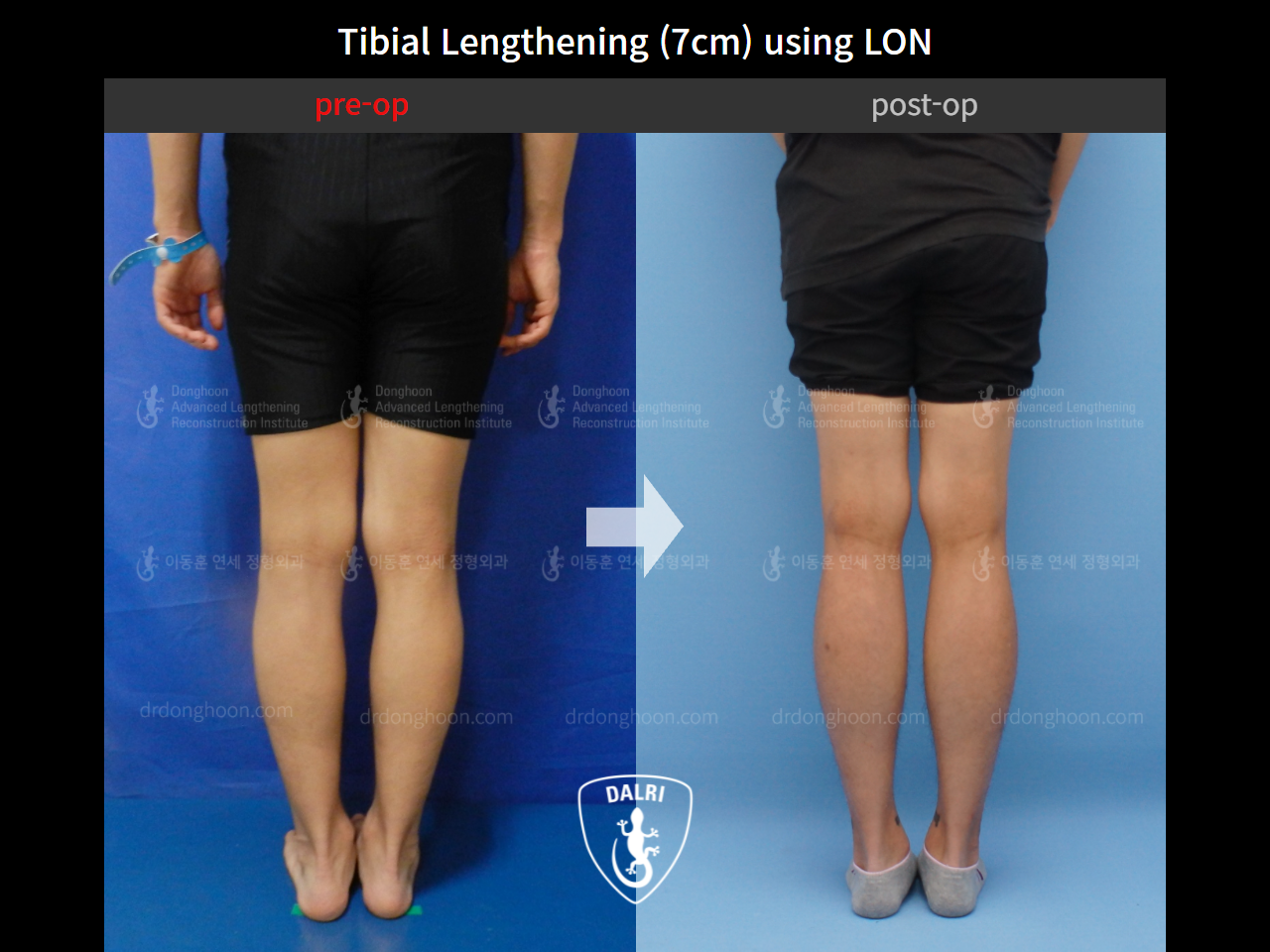 Before and after cll lon, case 4323927, image 4, Dr. Donghoon institute (DALRI)