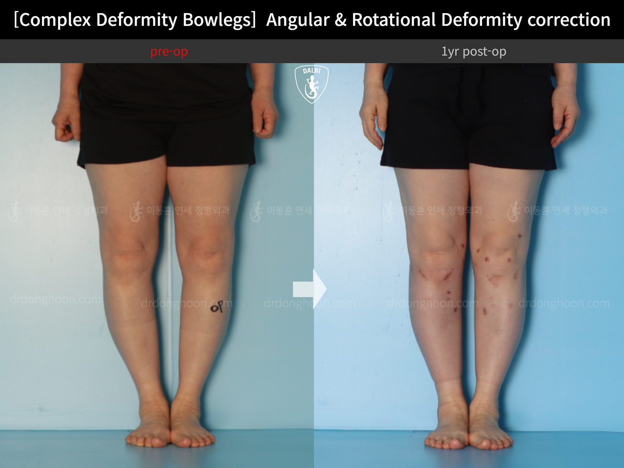 Before and after adult bowlegs, case 14378683, image 5, Dr. Donghoon institute (DALRI)