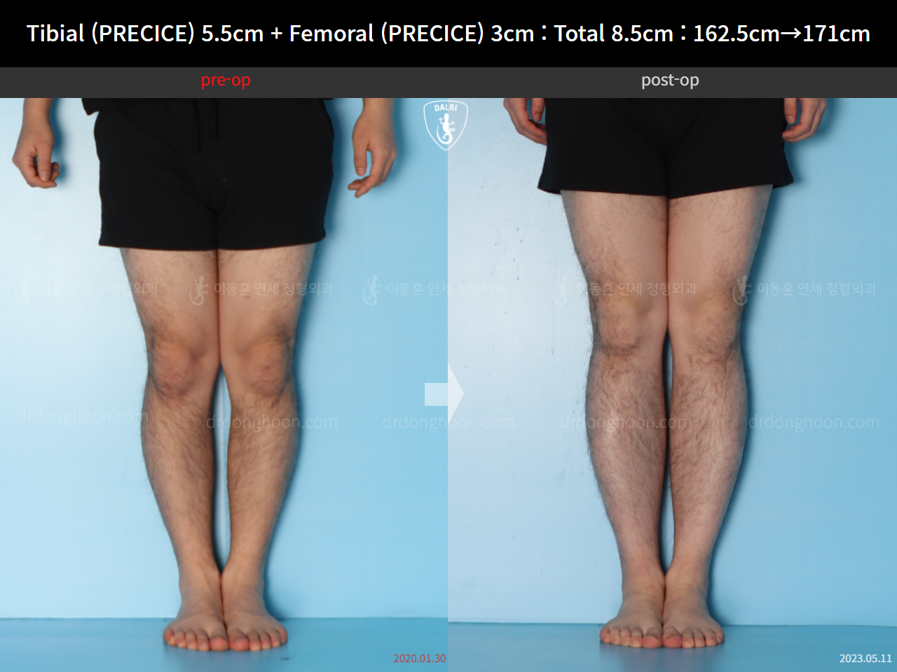 Before and after cll precice, case 15140008, image 5, Dr. Donghoon institute (DALRI)