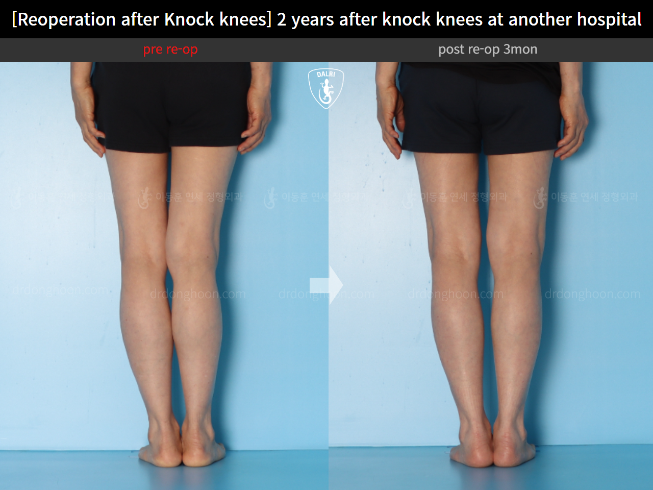 Before and after reoperation after deformity correction, case 15622876, image 9, Dr. Donghoon institute (DALRI)