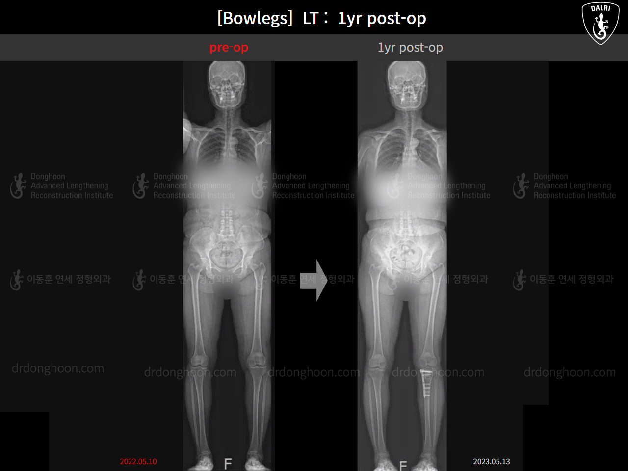Before and after adult bowlegs, case 15172734, image 11, Dr. Donghoon institute (DALRI)