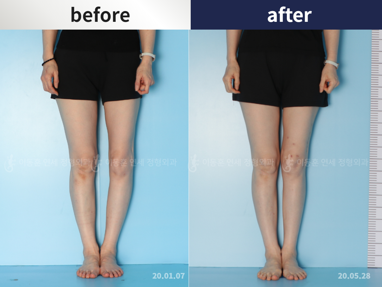 Before and after adult bowlegs, case 5987521, image 1, Dr. Donghoon institute (DALRI)