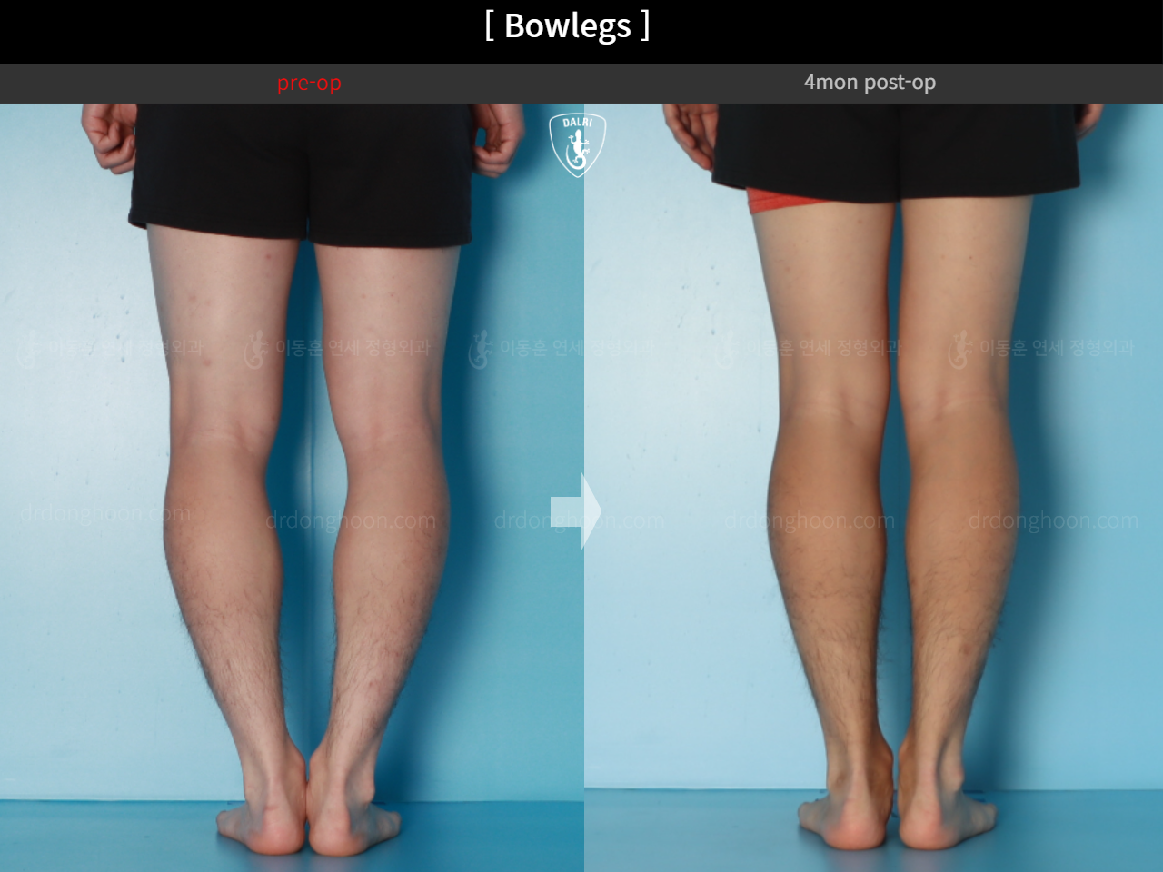 Before and after adult bowlegs, case 18479637, image 9, Dr. Donghoon institute (DALRI)
