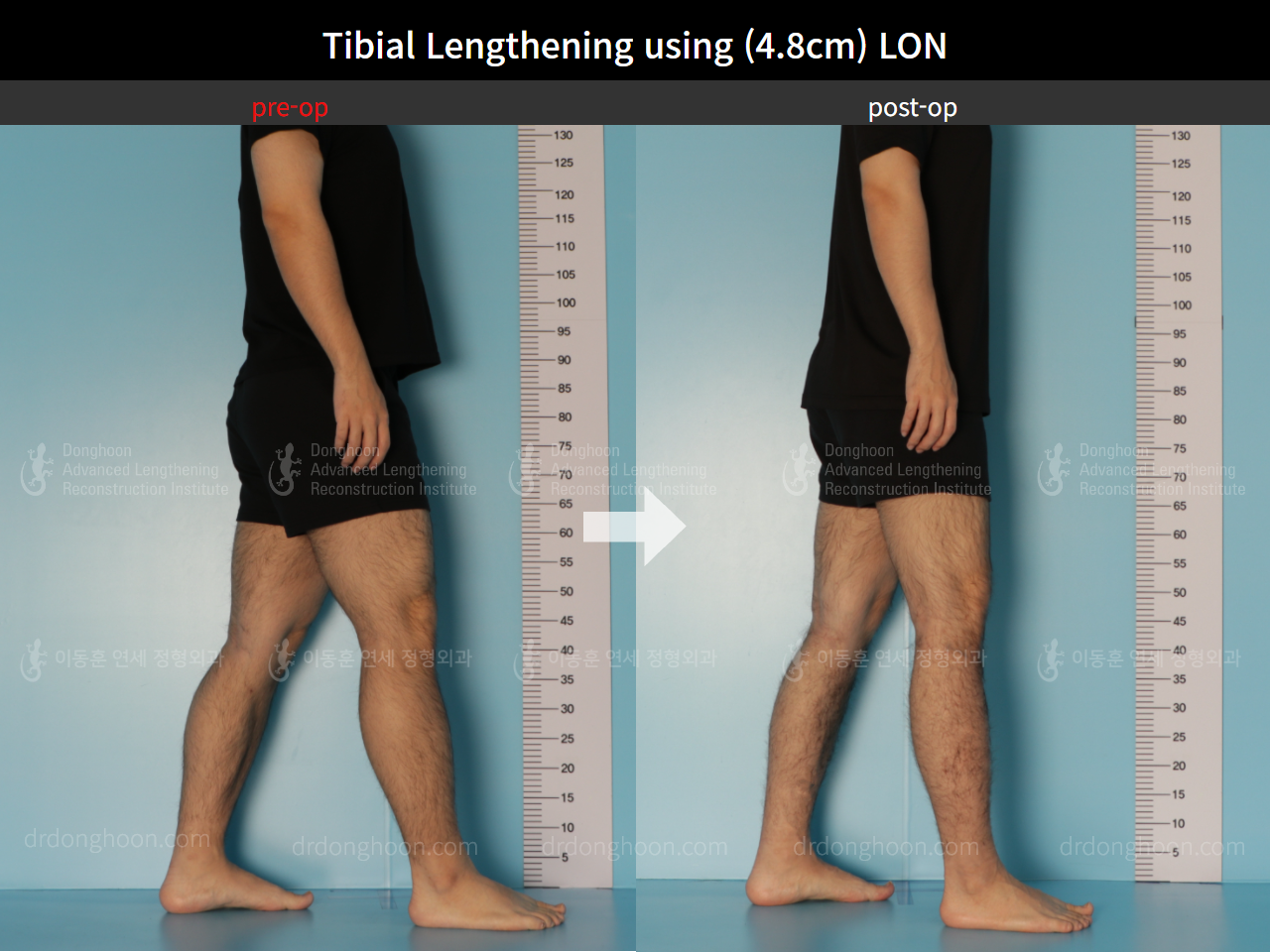 Before and after cll lon, case 8826653, image 3, Dr. Donghoon institute (DALRI)