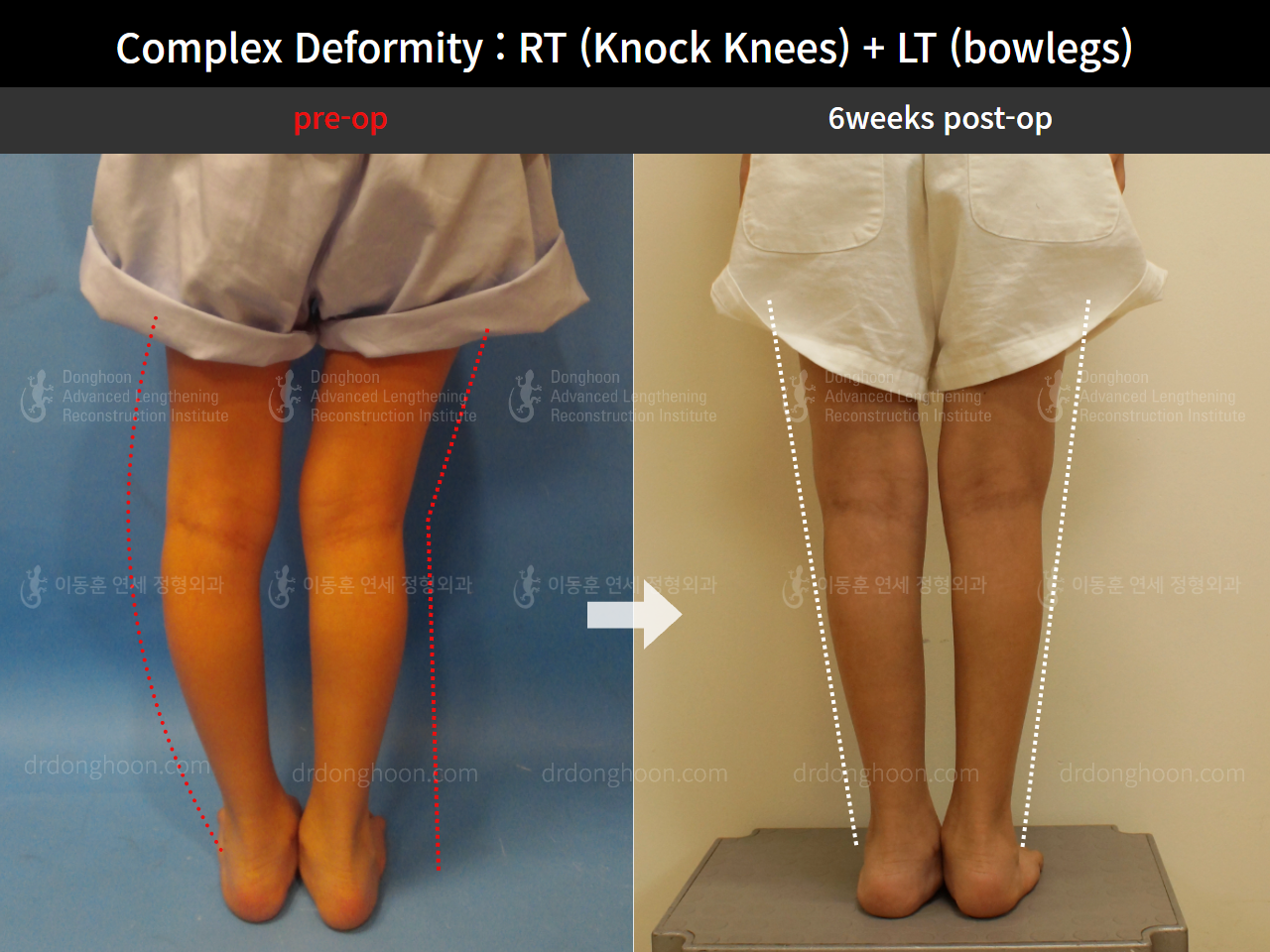 Before and after paediatric & adolescent knock knees, case 8618379, image 4, Dr. Donghoon institute (DALRI)