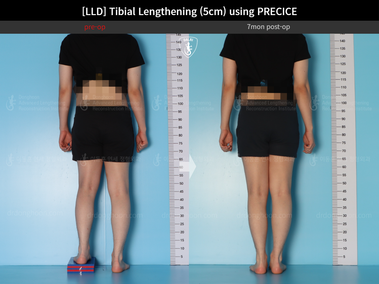 Before and after adult lld, case 18471613, image 2, Dr. Donghoon institute (DALRI)