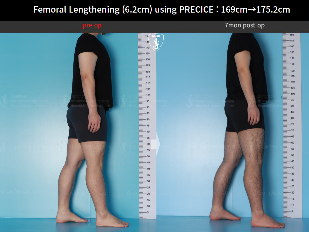 Before and after cll precice, case 20671201, image 5, Dr. Donghoon institute (DALRI)