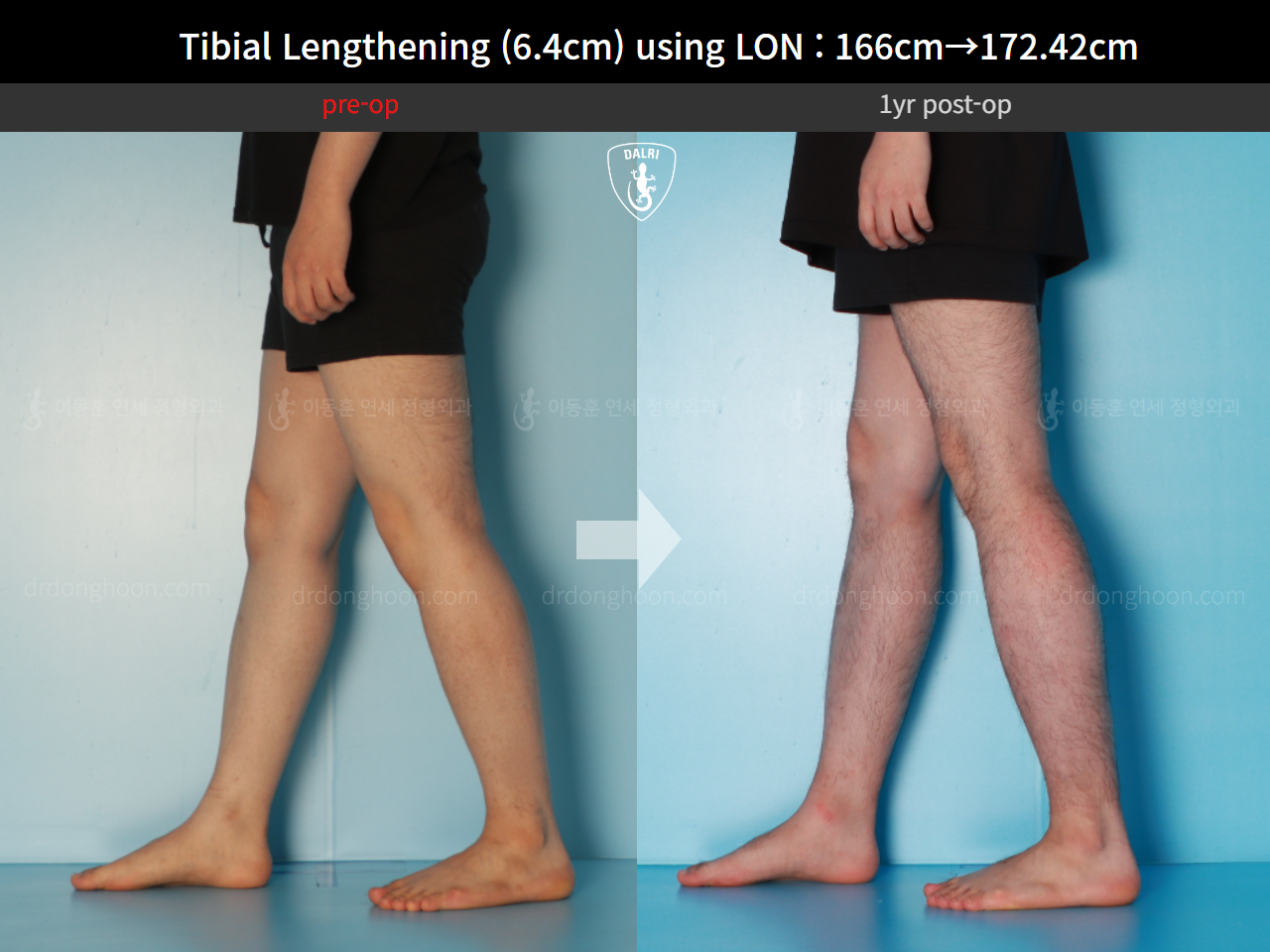 Before and after cll lon, case 15889727, image 9, Dr. Donghoon institute (DALRI)