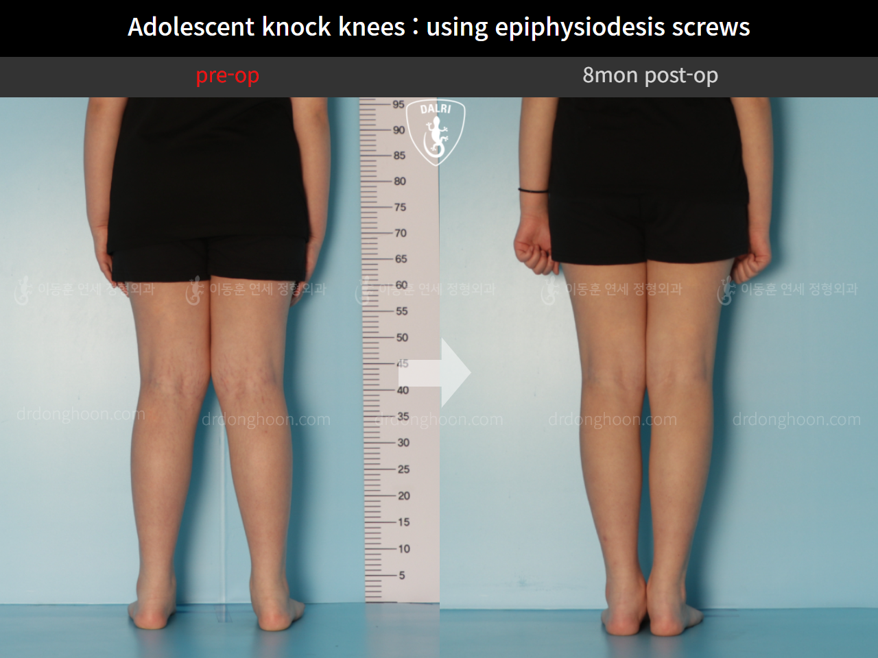 Before and after paediatric & adolescent knock knees, case 10297056, image 4, Dr. Donghoon institute (DALRI)
