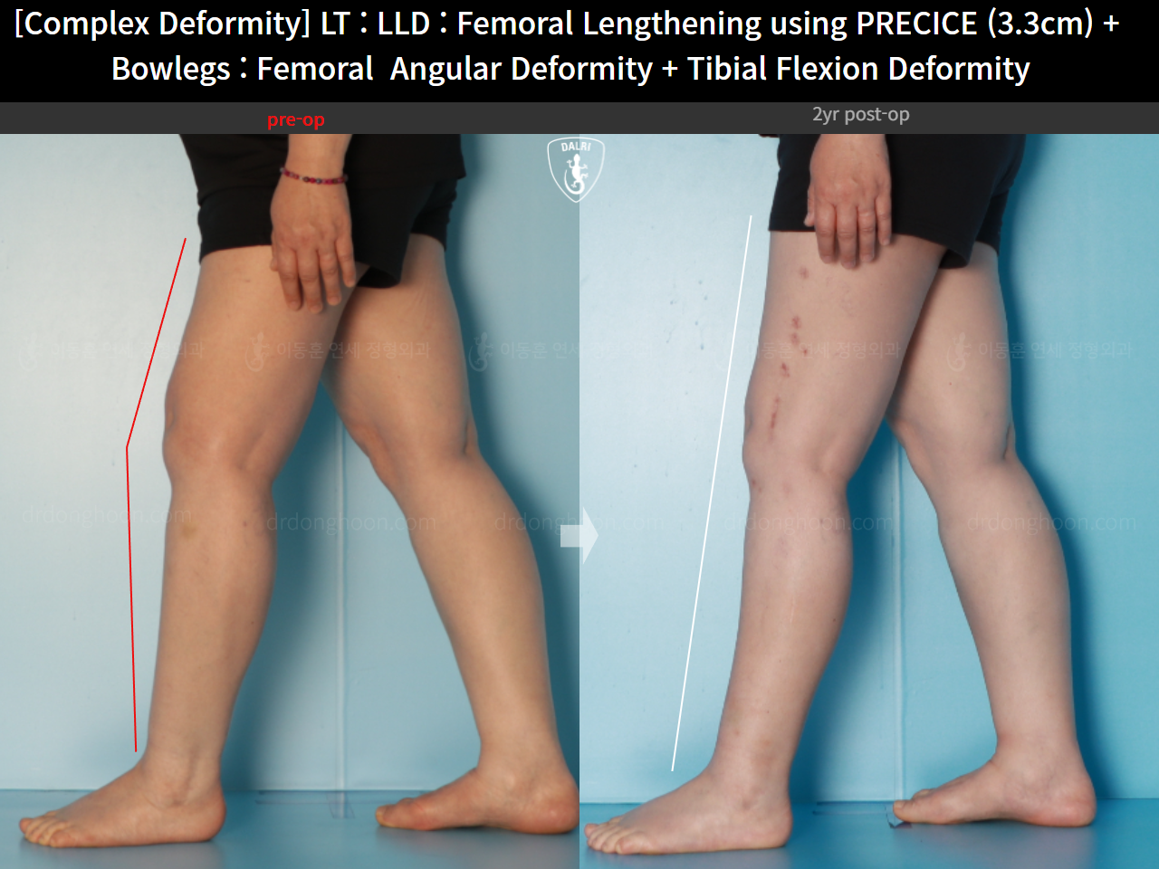 Before and after flexion deformity, case 16786725, image 3, Dr. Donghoon institute (DALRI)