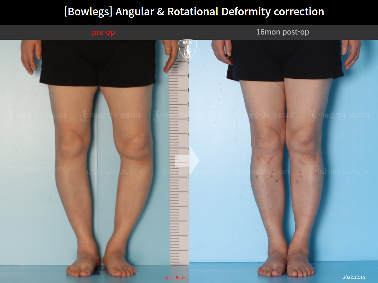 Before and after adult bowlegs, case 14637299, image 3, Dr. Donghoon institute (DALRI)
