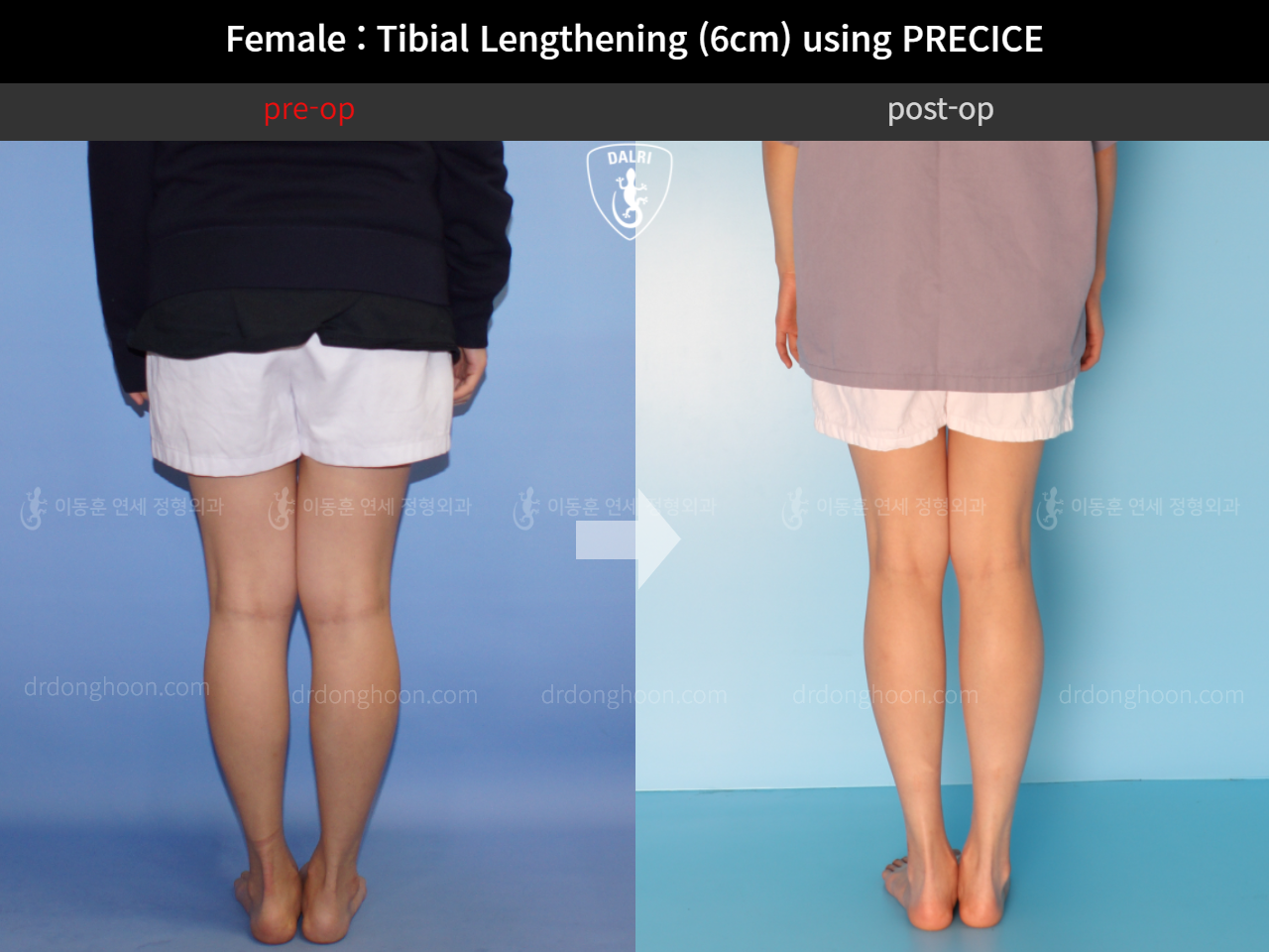 Before and after cll precice, case 11653827, image 6, Dr. Donghoon institute (DALRI)