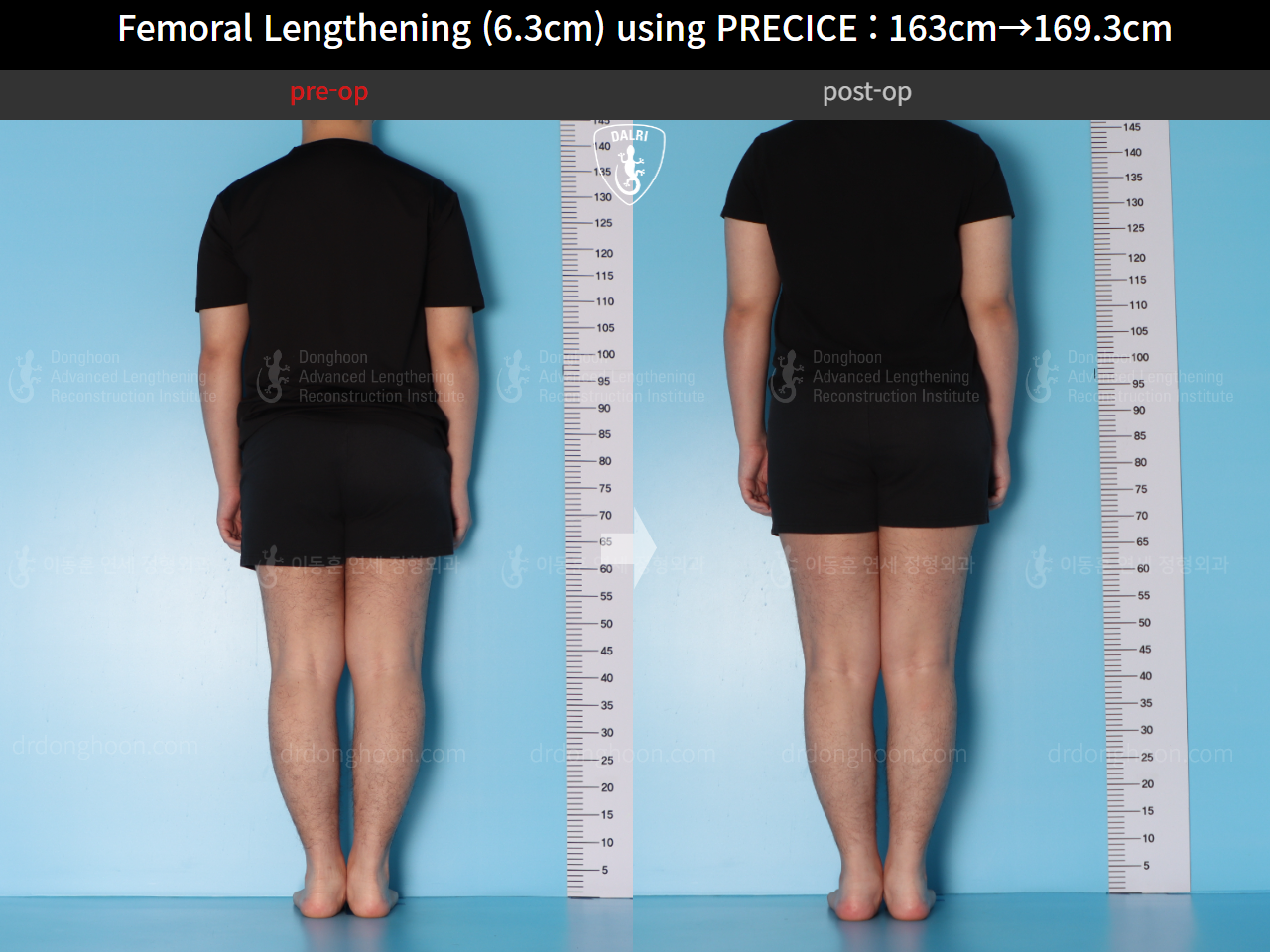 Before and after cll precice, case 15639837, image 3, Dr. Donghoon institute (DALRI)