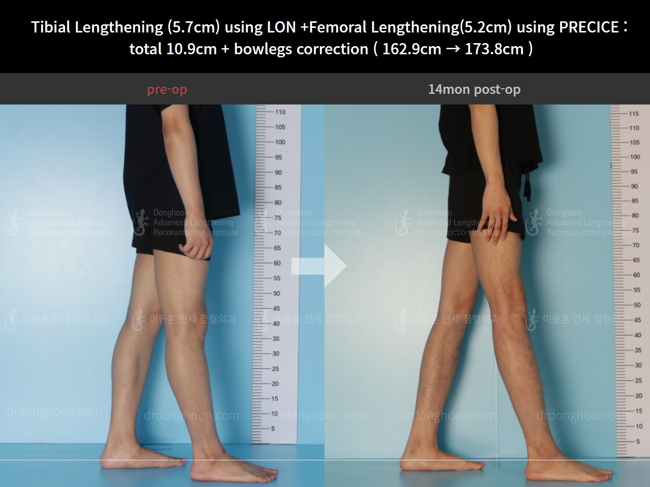 Before and after cll + deformity correction, case 8417894, image 3, Dr. Donghoon institute (DALRI)