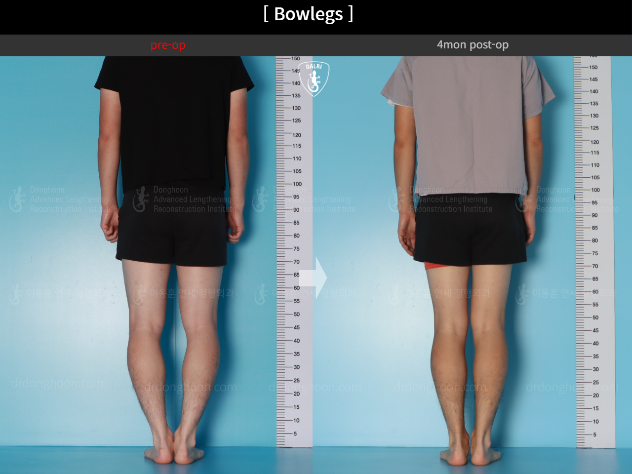 Before and after adult bowlegs, case 18479637, image 4, Dr. Donghoon institute (DALRI)