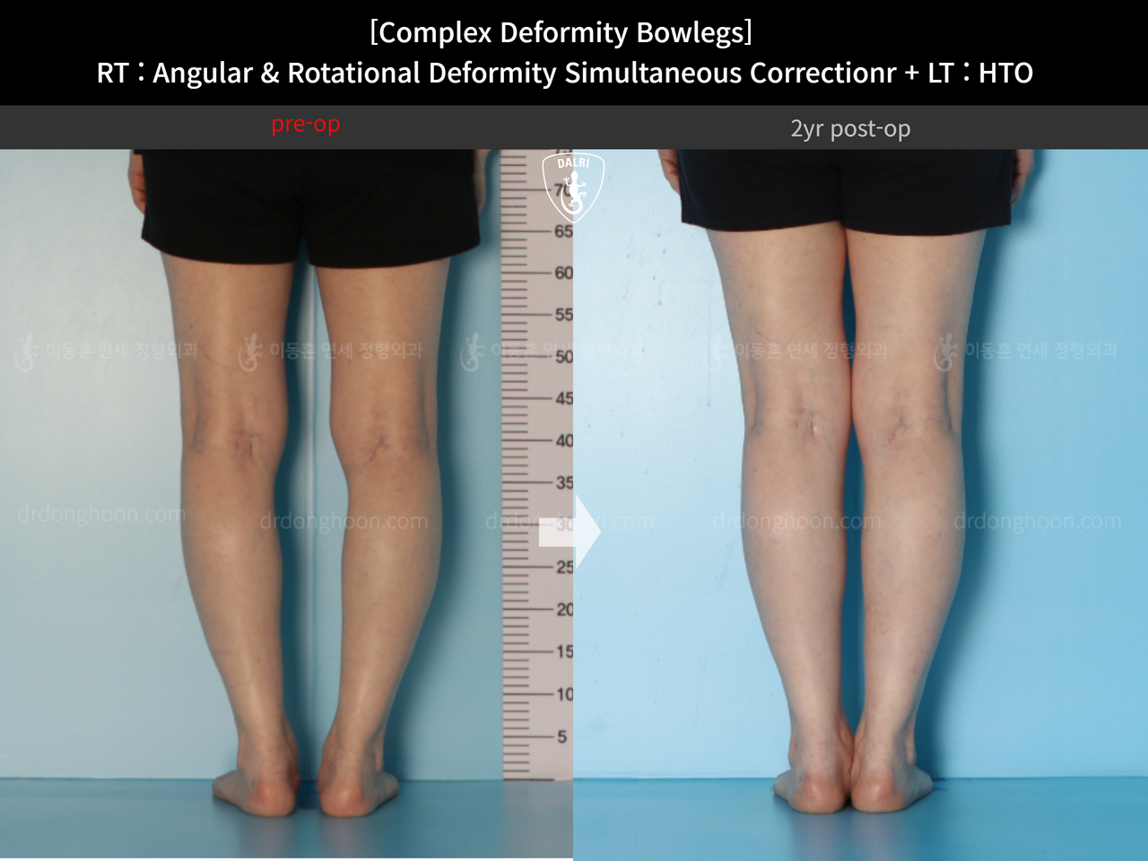 Before and after adult bowlegs, case 14328178, image 5, Dr. Donghoon institute (DALRI)