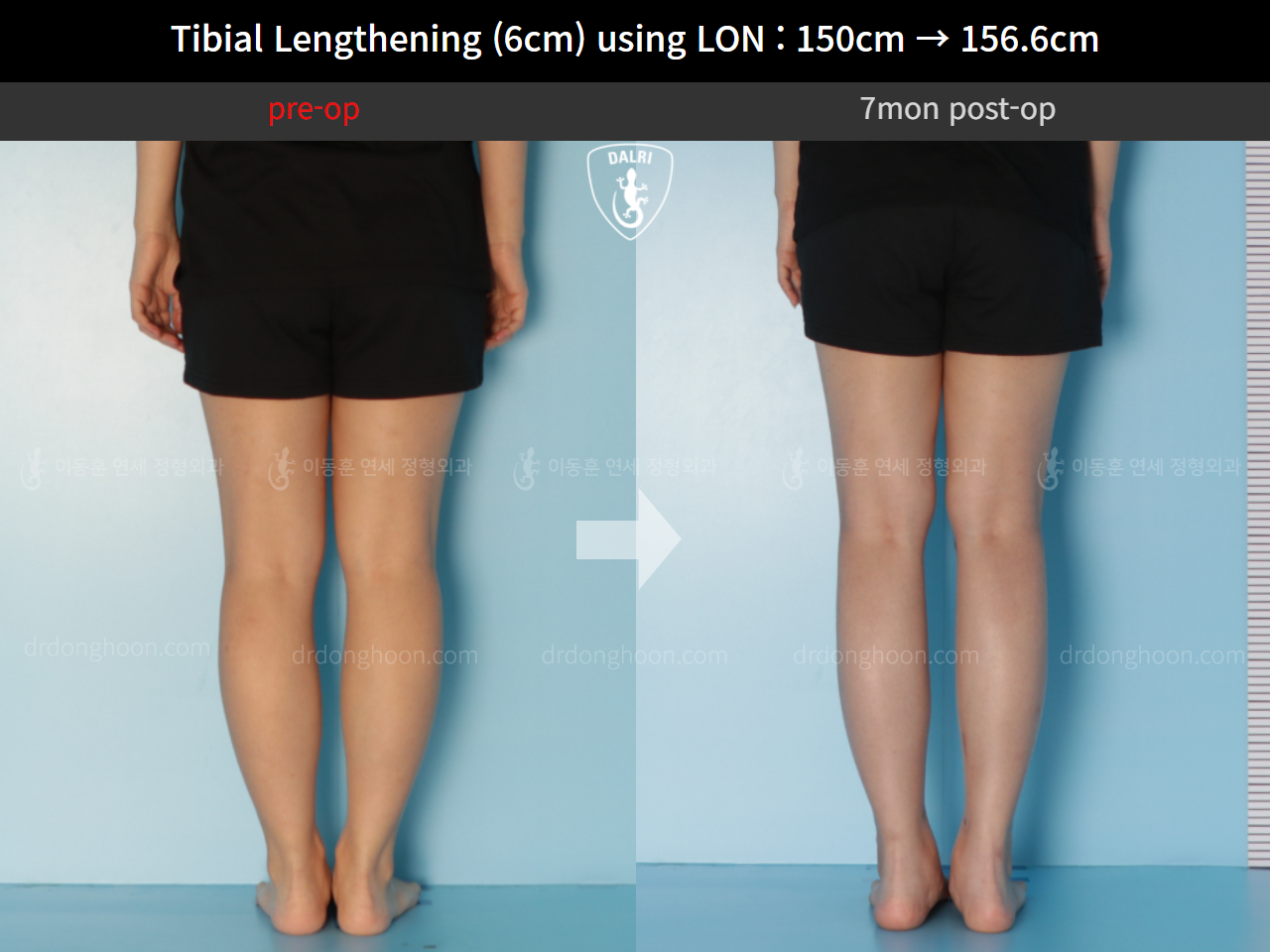 Before and after cll lon, case 9992030, image 6, Dr. Donghoon institute (DALRI)