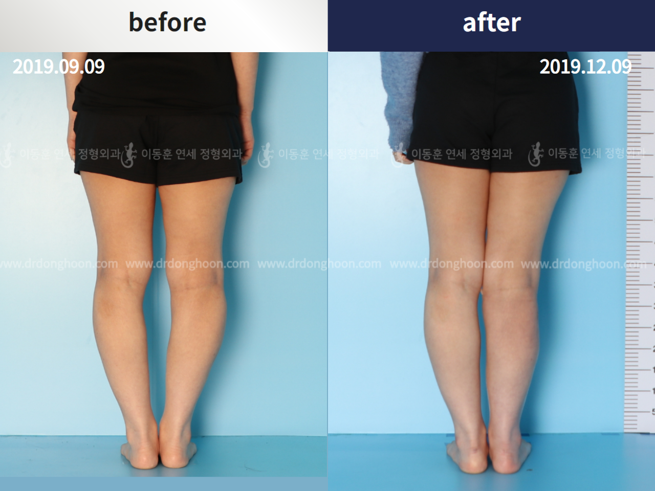 Before and after congenital condition, case 4396483, image 2, Dr. Donghoon institute (DALRI)