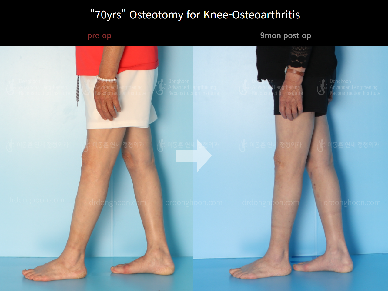 Before and after osteotomy for knee osteoarthritis, case 4306392, image 3, Dr. Donghoon institute (DALRI)