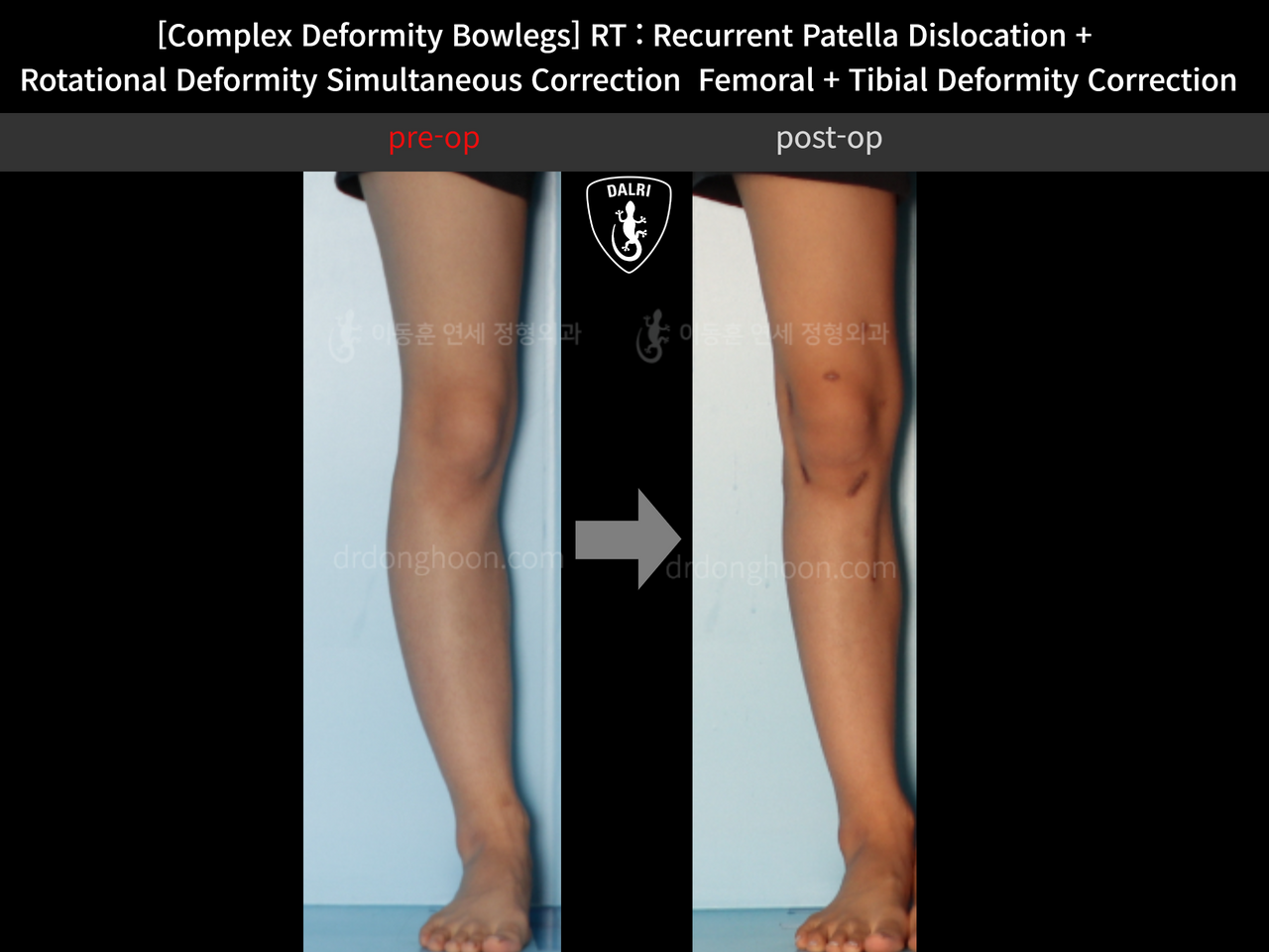 Before and after complex deformity, case 12255273, image 3, Dr. Donghoon institute (DALRI)