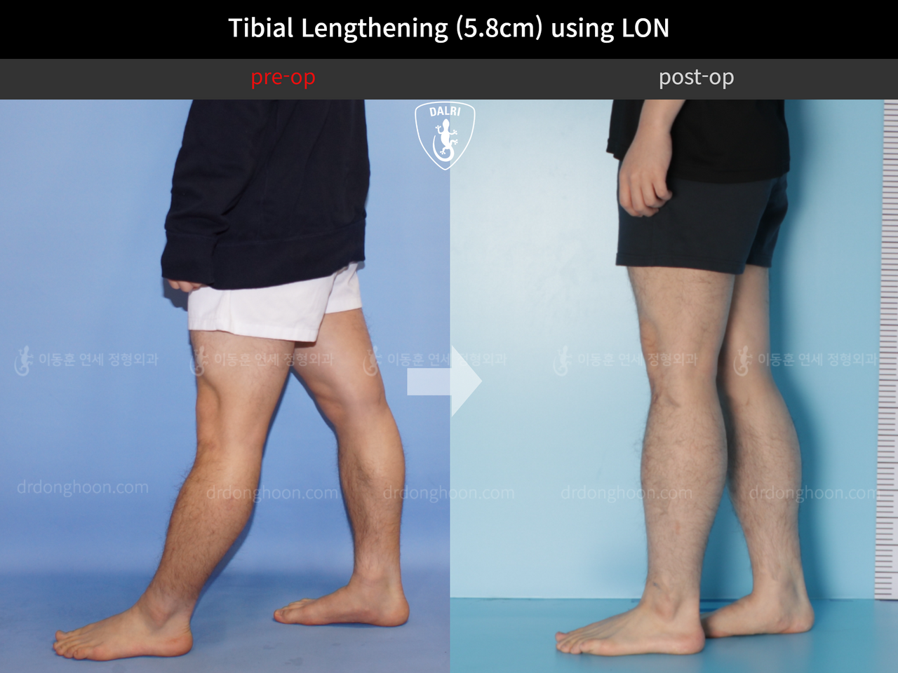 Before and after cll lon, case 4577732, image 7, Dr. Donghoon institute (DALRI)