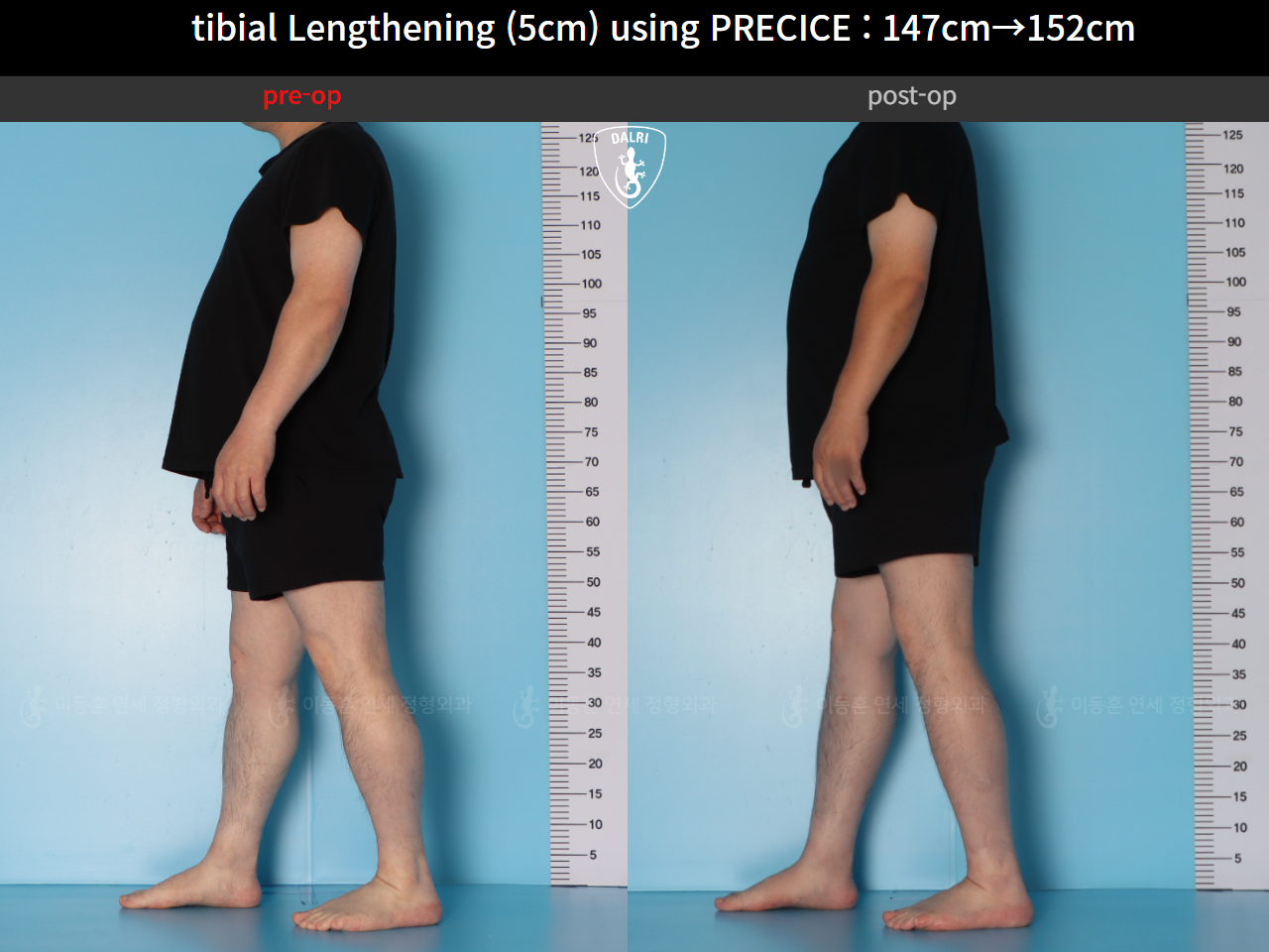 Before and after cll precice, case 89098588, image 4, Dr. Donghoon institute (DALRI)