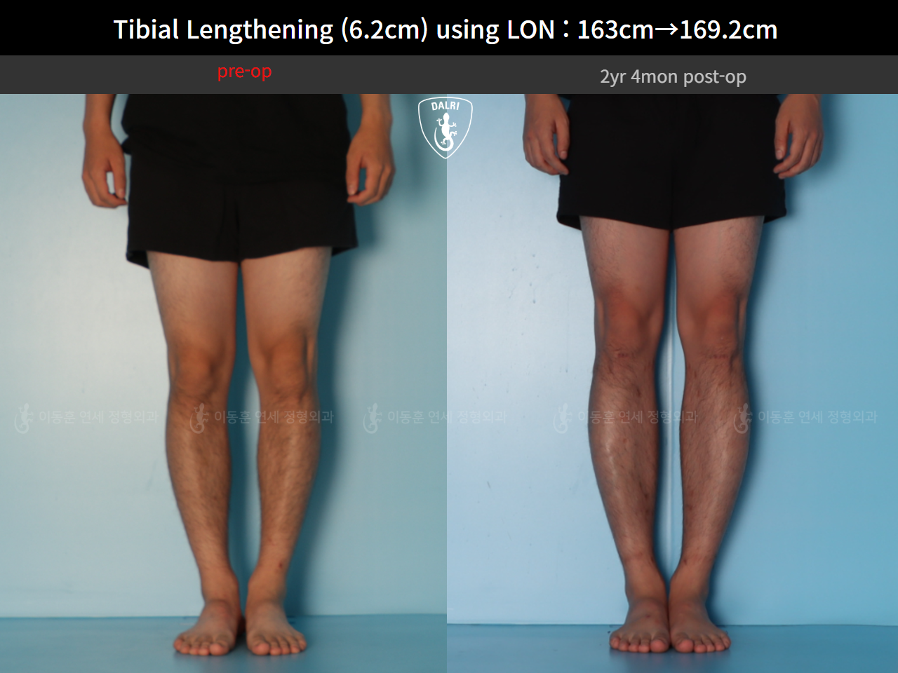 Before and after cll lon, case 128449546, image 7, Dr. Donghoon institute (DALRI)