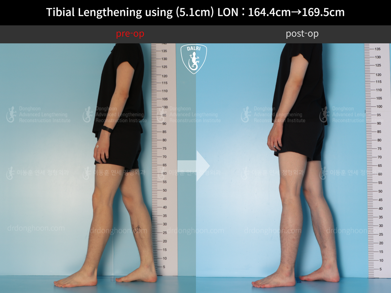 Before and after cll lon, case 12653375, image 4, Dr. Donghoon institute (DALRI)