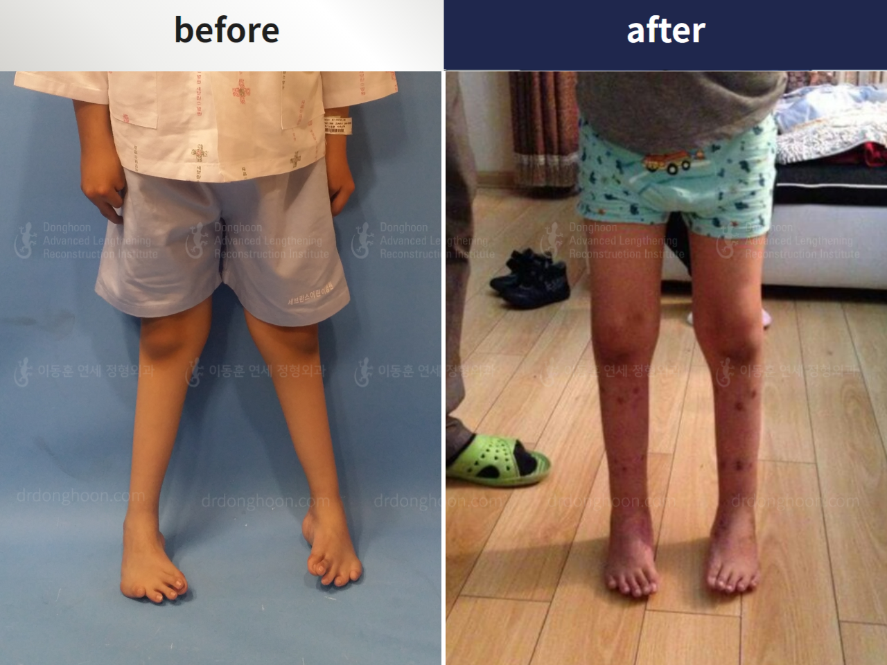 Before and after foot & ankle deformity, case 4367968, image 2, Dr. Donghoon institute (DALRI)