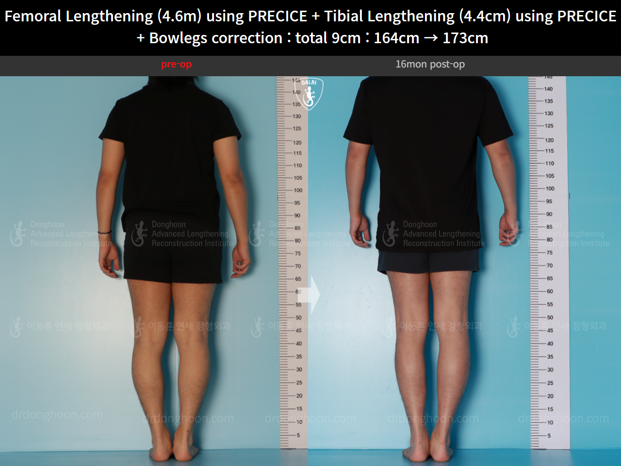 Before and after cll + deformity correction, case 16697522, image 3, Dr. Donghoon institute (DALRI)