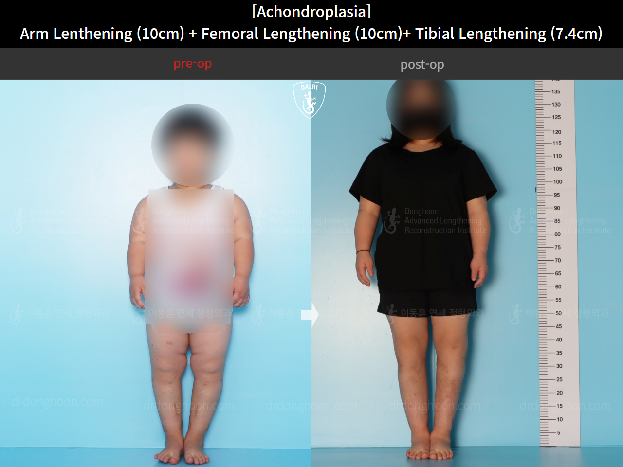 Before and after paediatric congenital condition, case 18310546, image 3, Dr. Donghoon institute (DALRI)