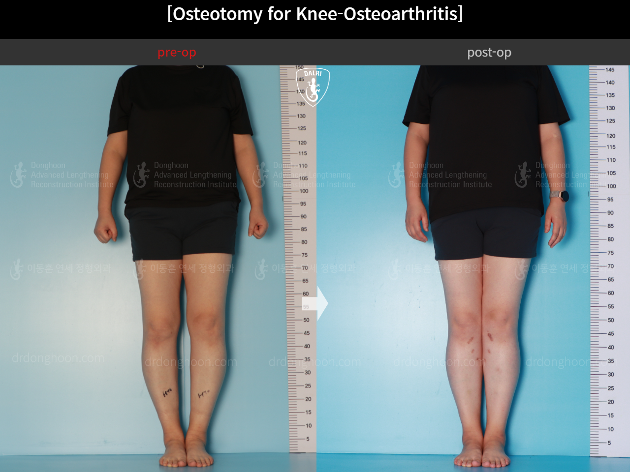 Before and after osteotomy for knee osteoarthritis, case 15944917, image 2, Dr. Donghoon institute (DALRI)