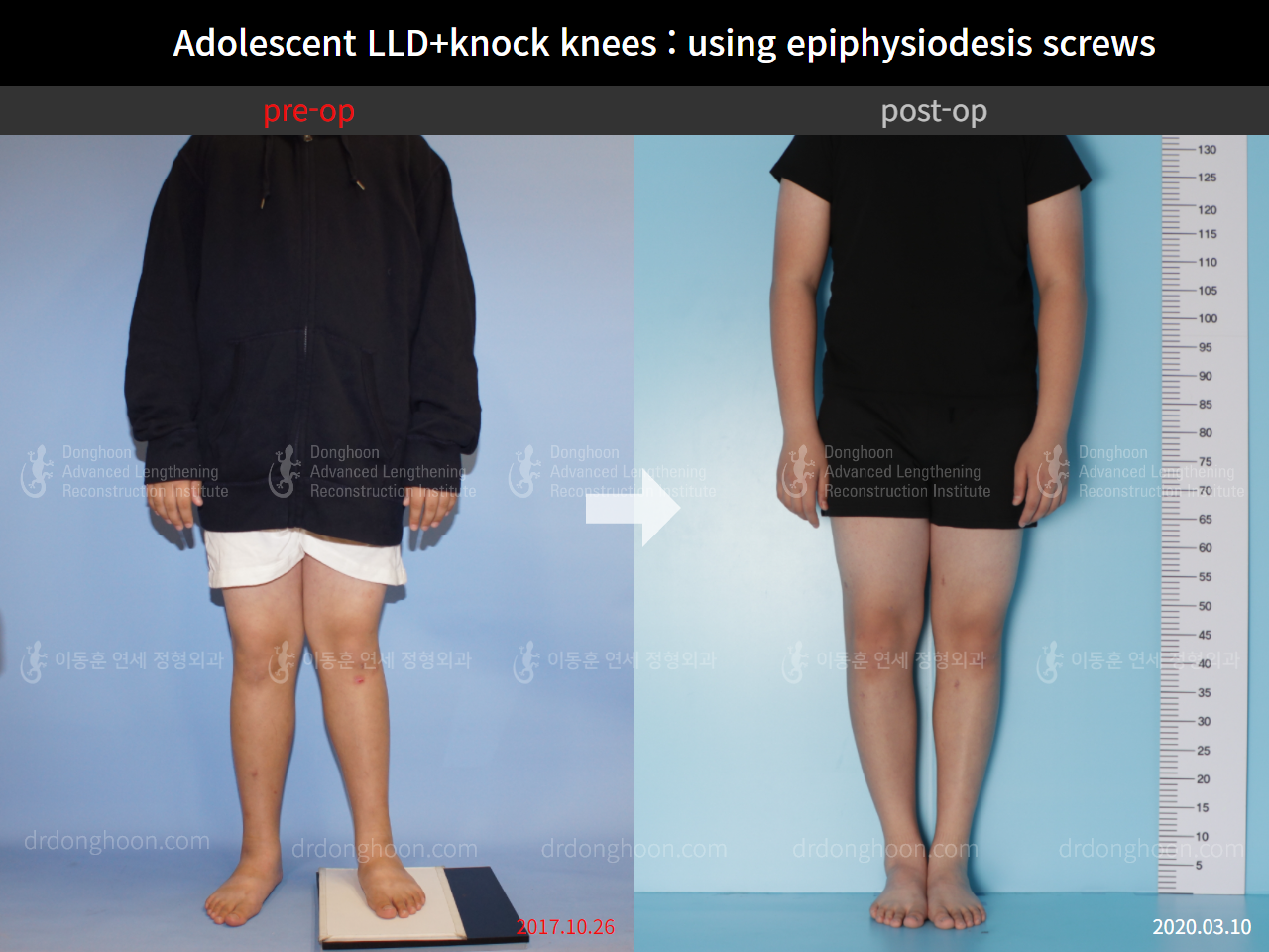 Before and after complex deformity, case 8835405, image 3, Dr. Donghoon institute (DALRI)