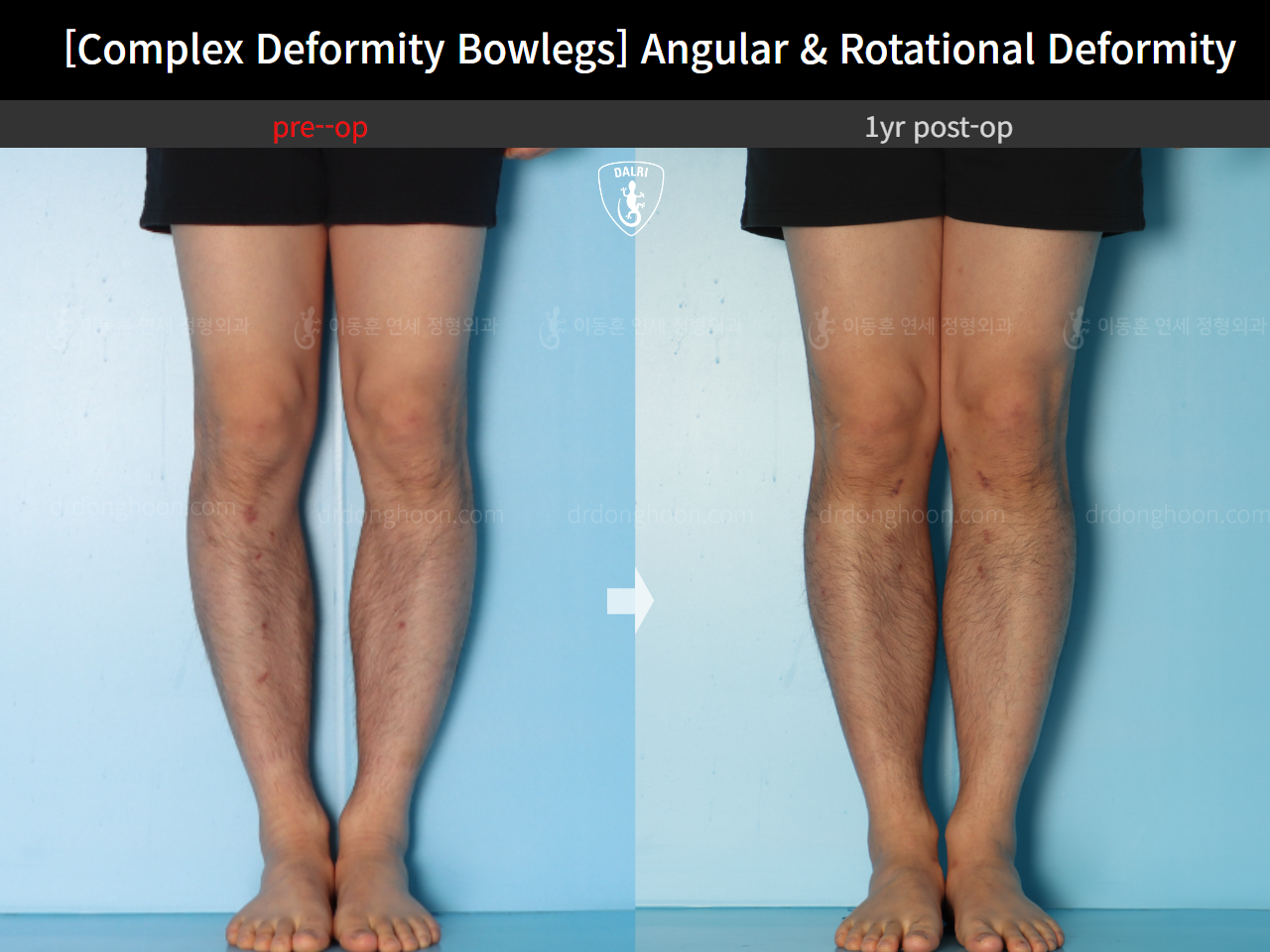Before and after adult bowlegs, case 17229195, image 4, Dr. Donghoon institute (DALRI)