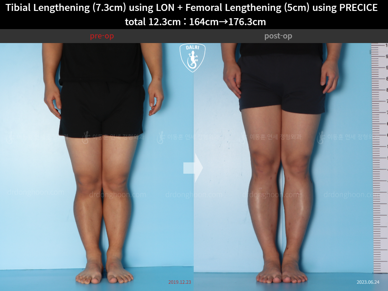 Before and after cll precice, case 15592732, image 5, Dr. Donghoon institute (DALRI)