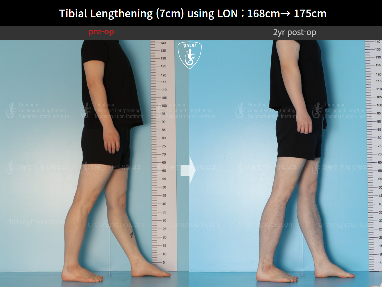 Before and after cll lon, case 14978046, image 6, Dr. Donghoon institute (DALRI)
