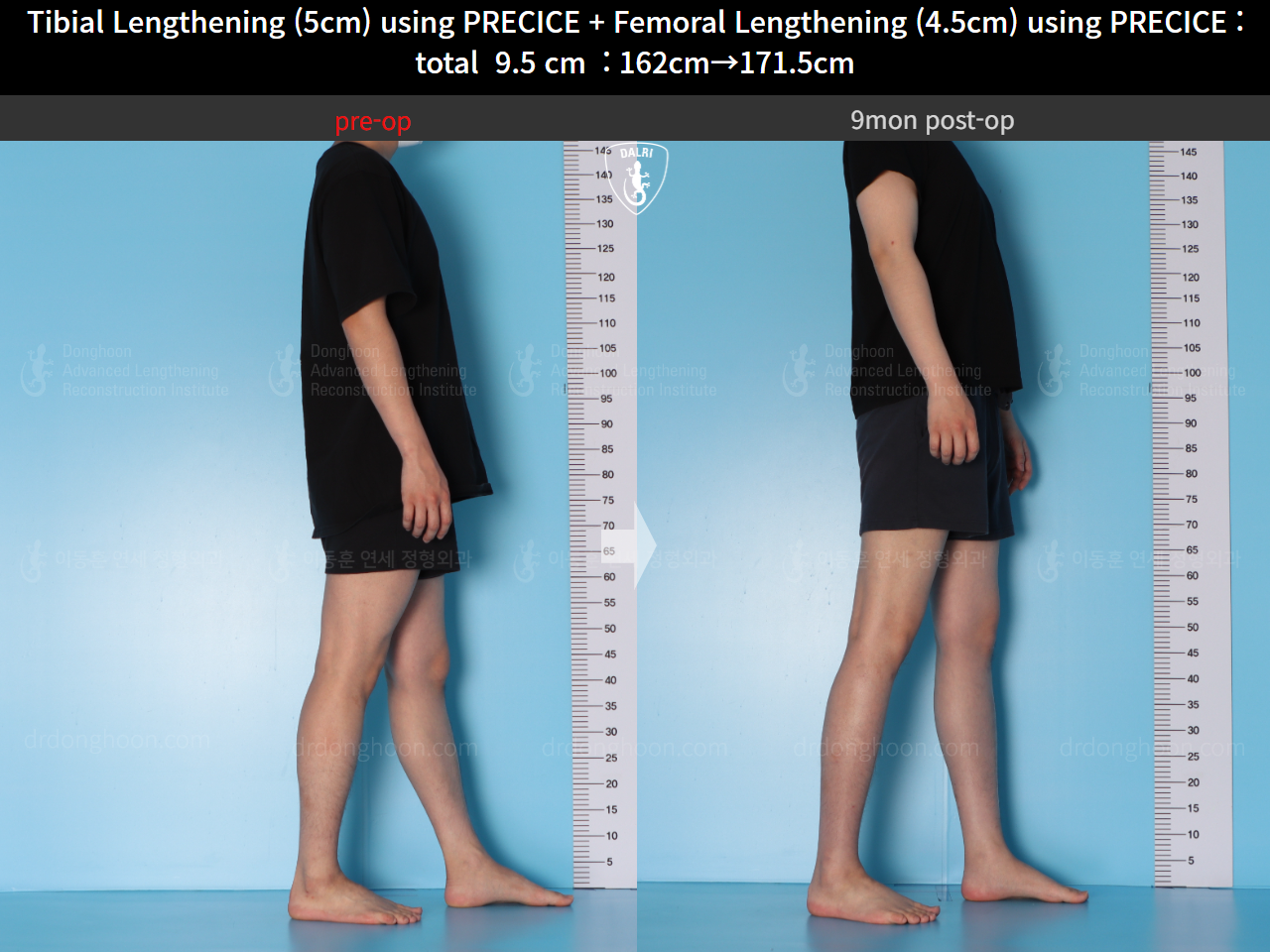 Before and after cll precice, case 15344460, image 6, Dr. Donghoon institute (DALRI)