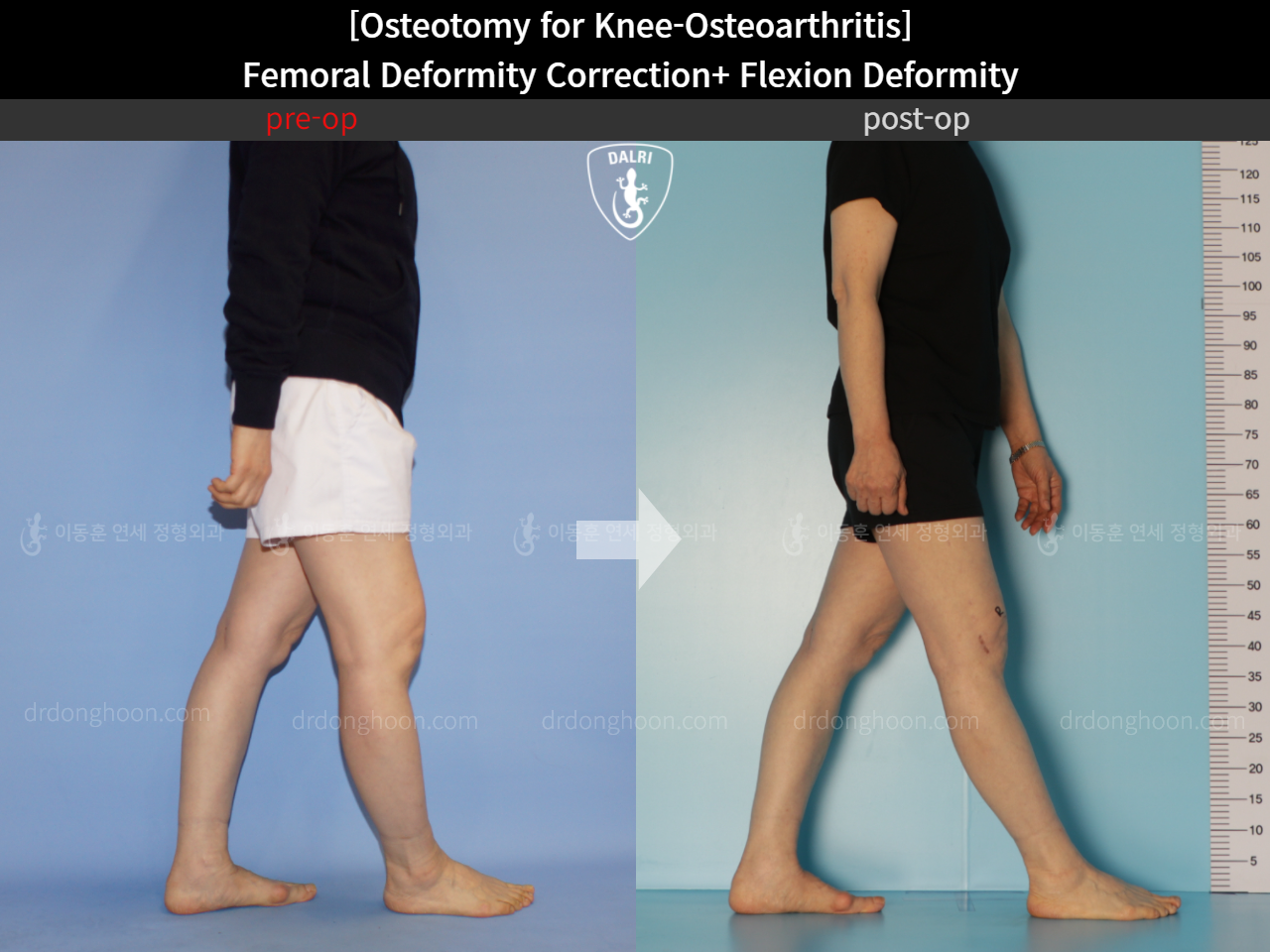 Before and after osteotomy for knee osteoarthritis, case 11380349, image 7, Dr. Donghoon institute (DALRI)