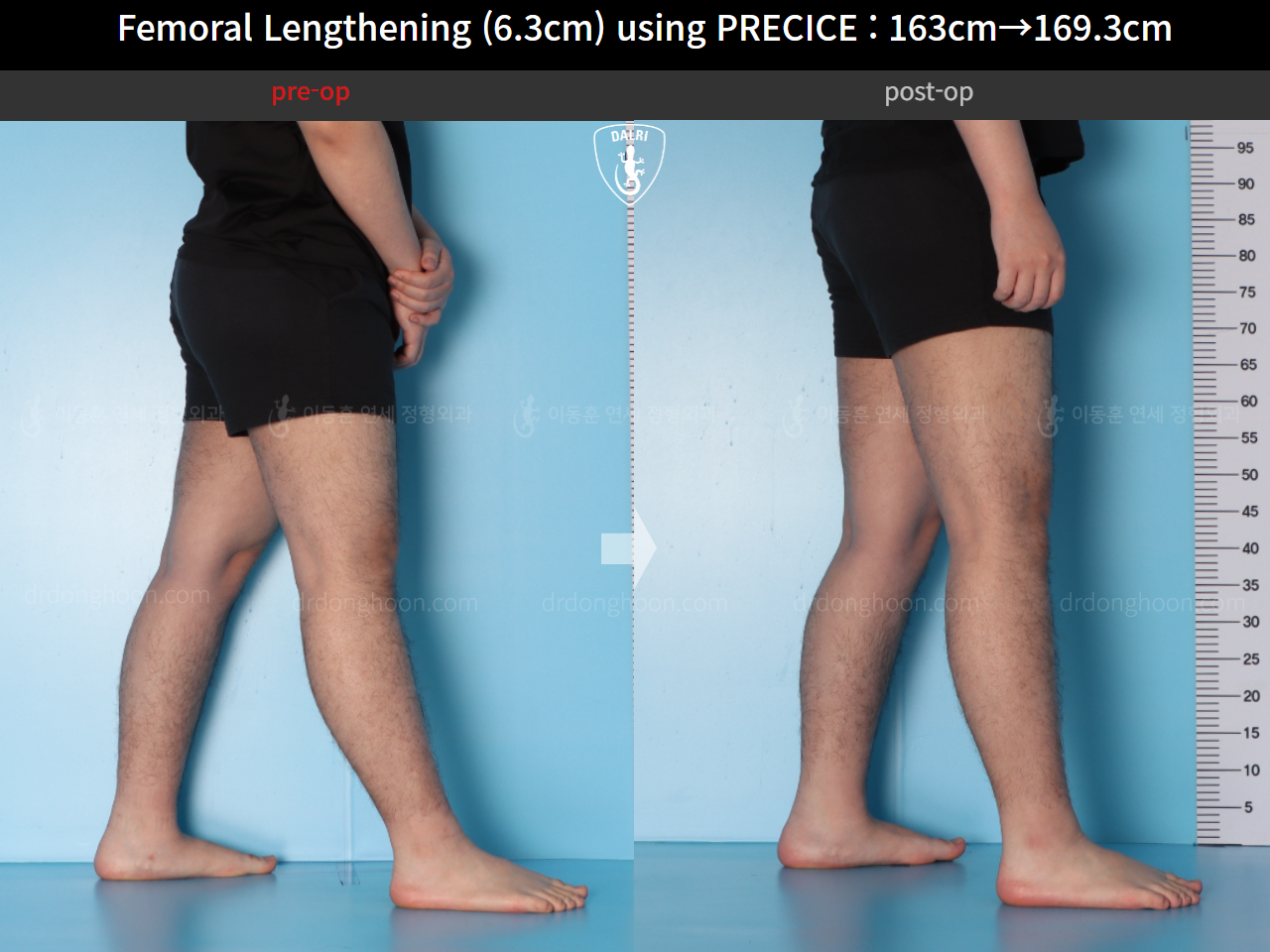 Before and after cll precice, case 15639837, image 12, Dr. Donghoon institute (DALRI)