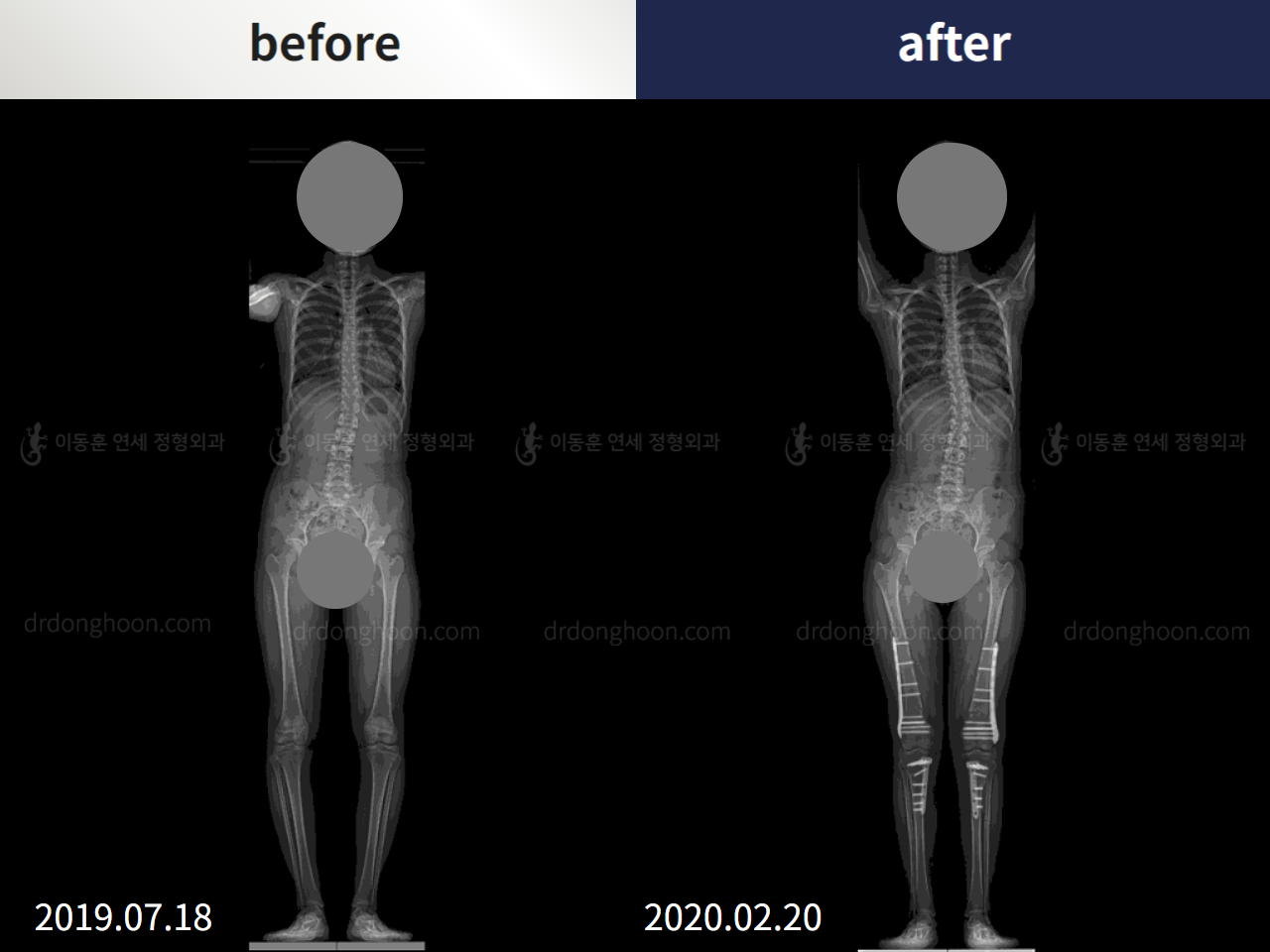 Before and after complex deformity, case 5905795, image 2, Dr. Donghoon institute (DALRI)