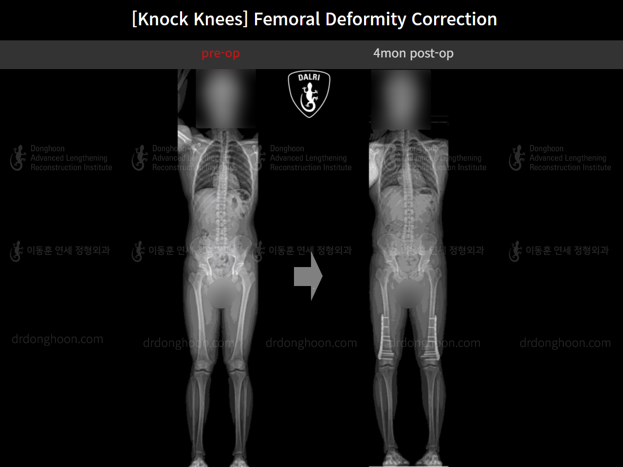 Before and after adult knock knees, case 15816319, image 10, Dr. Donghoon institute (DALRI)