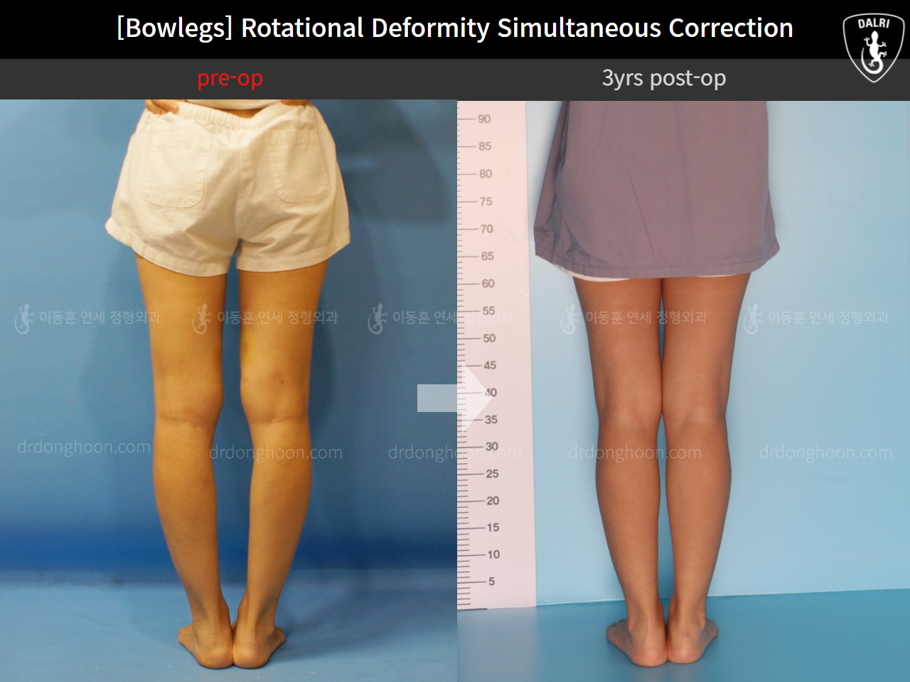 Before and after adult bowlegs, case 11789553, image 7, Dr. Donghoon institute (DALRI)
