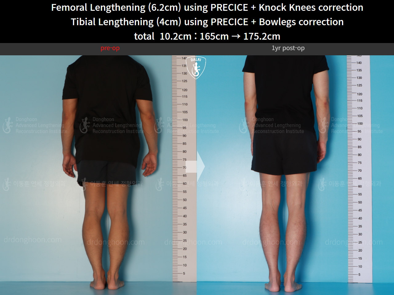 Before and after cll + deformity correction, case 15903252, image 4, Dr. Donghoon institute (DALRI)